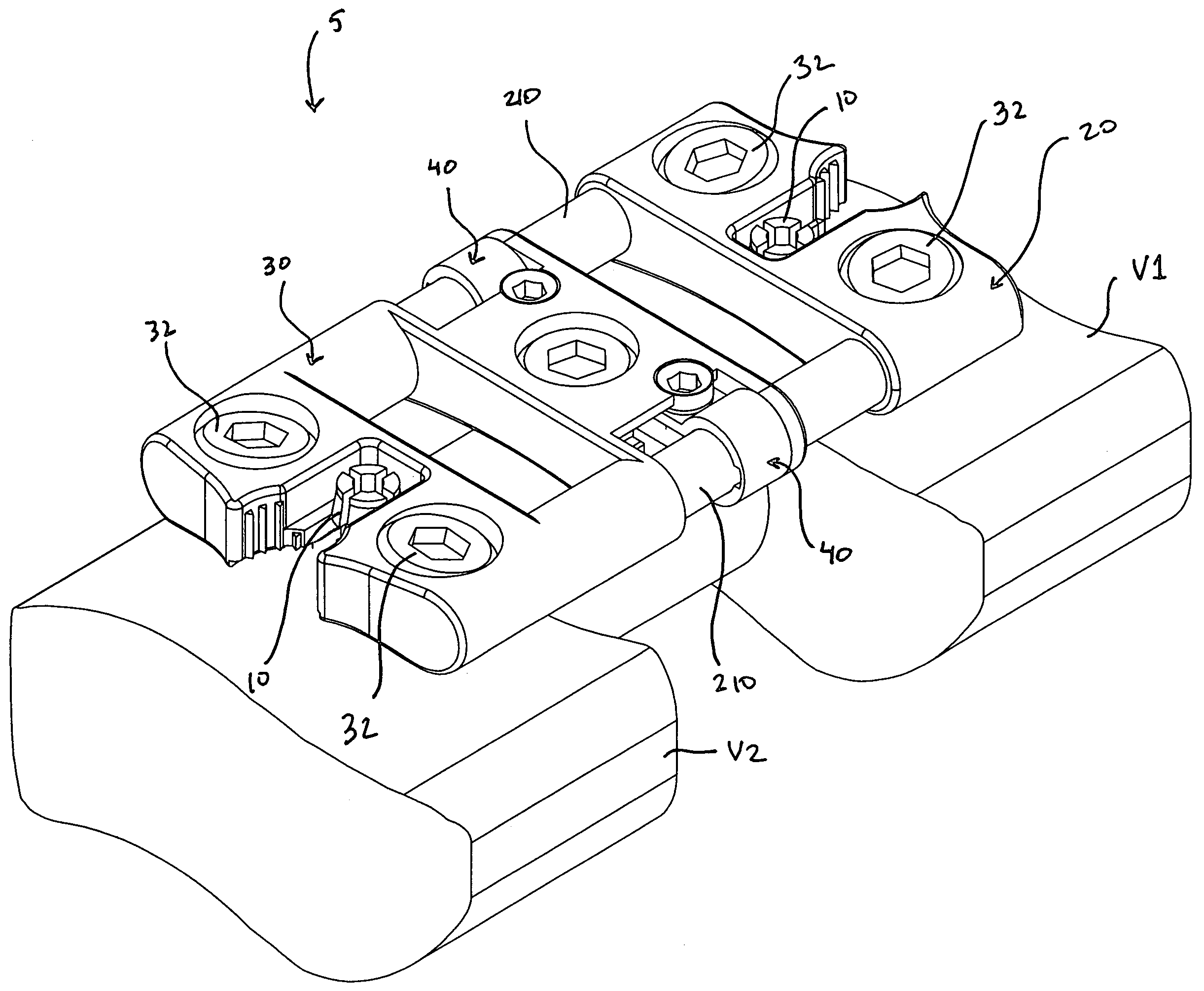 Bone fixation system and method of implantation