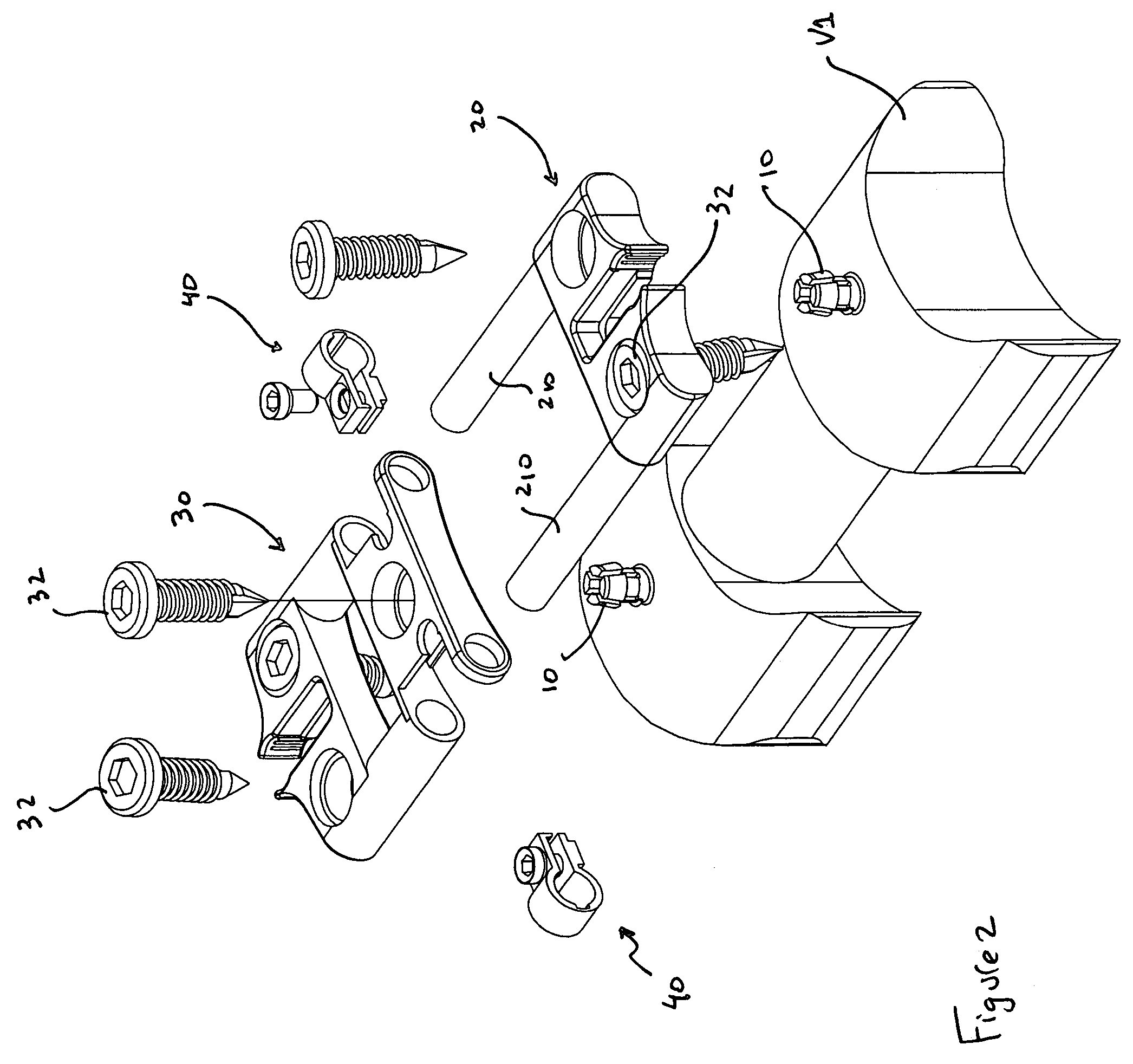 Bone fixation system and method of implantation