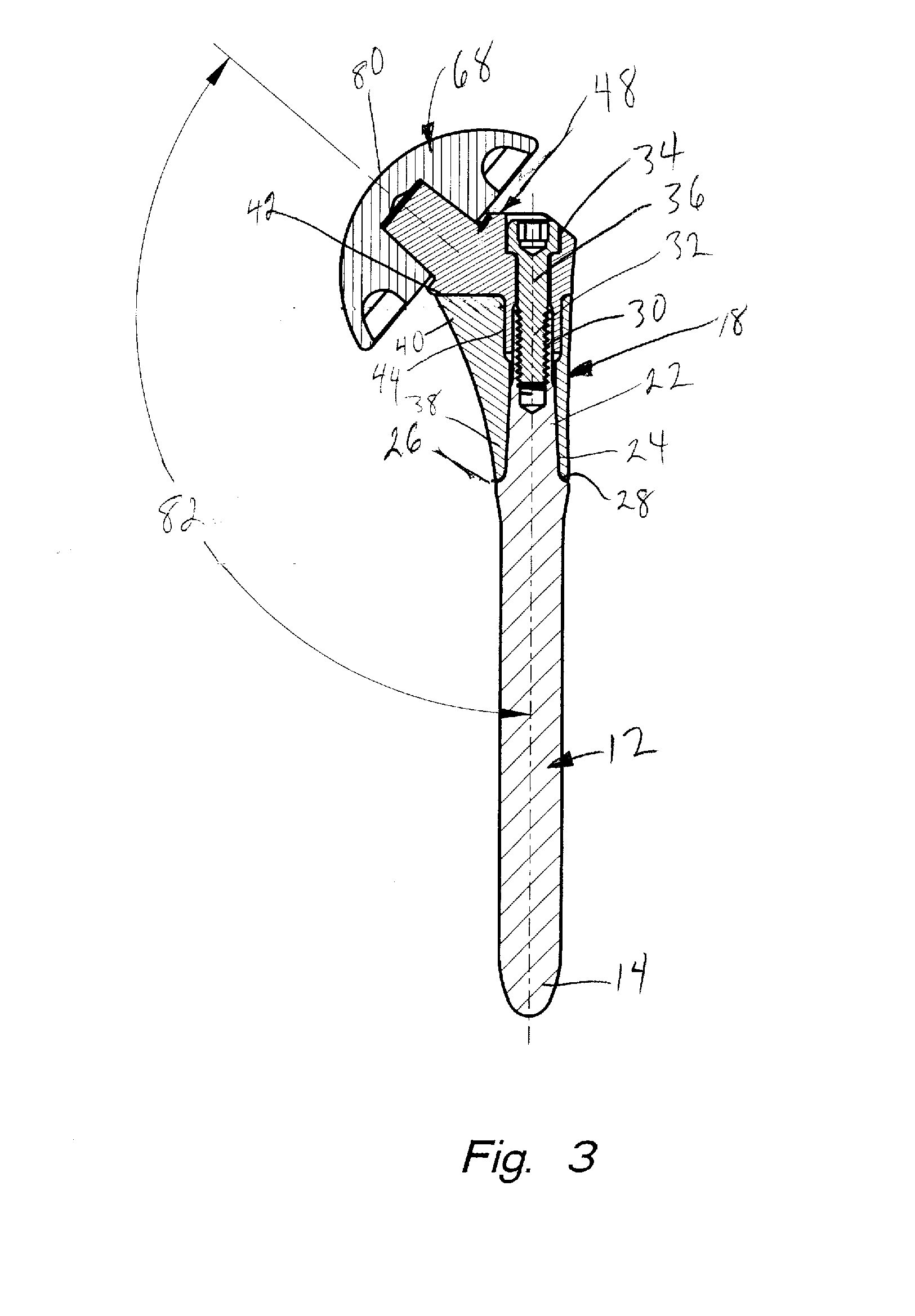 Modular shoulder prosthesis