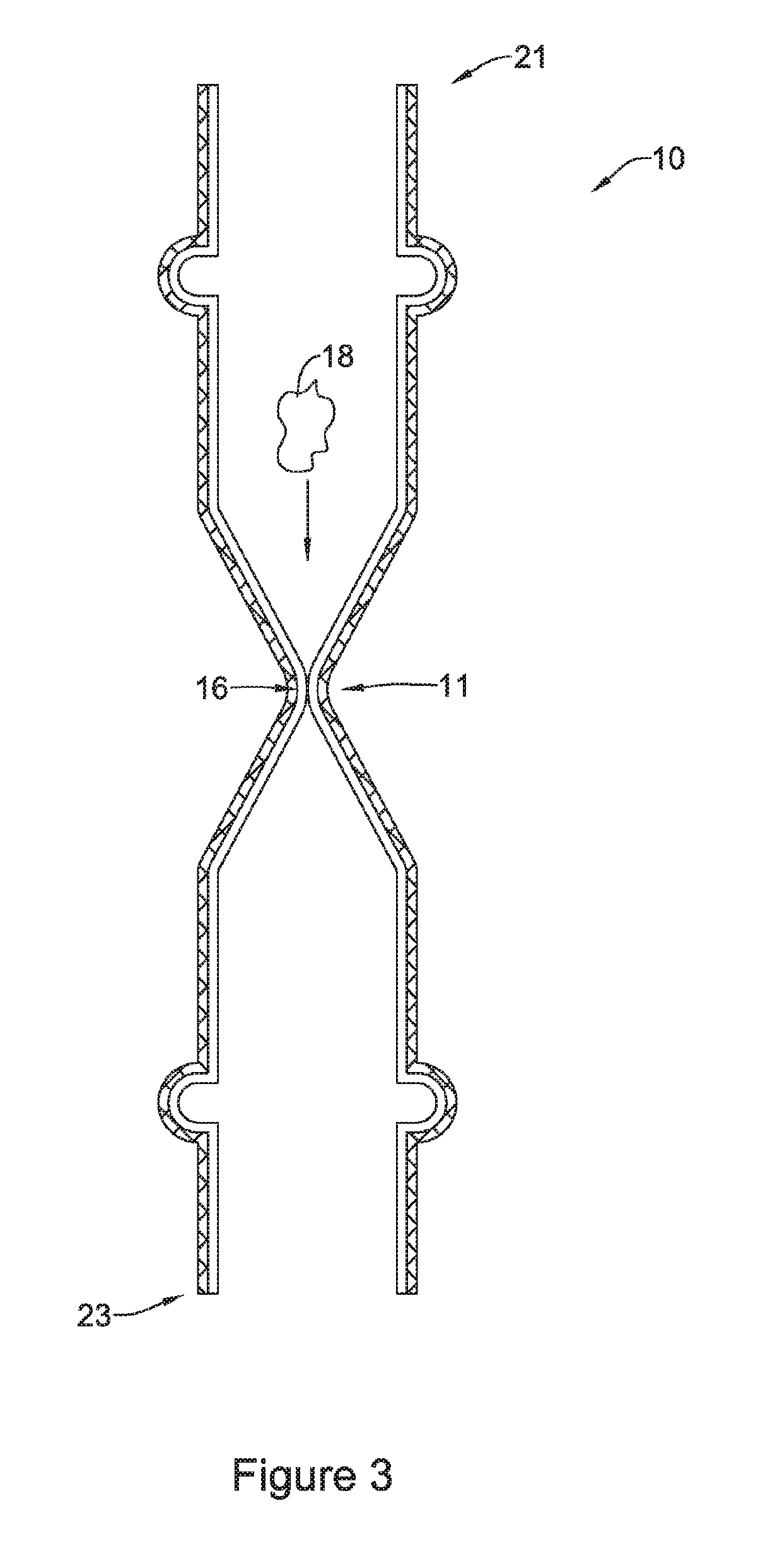 Esophageal stent including a valve member