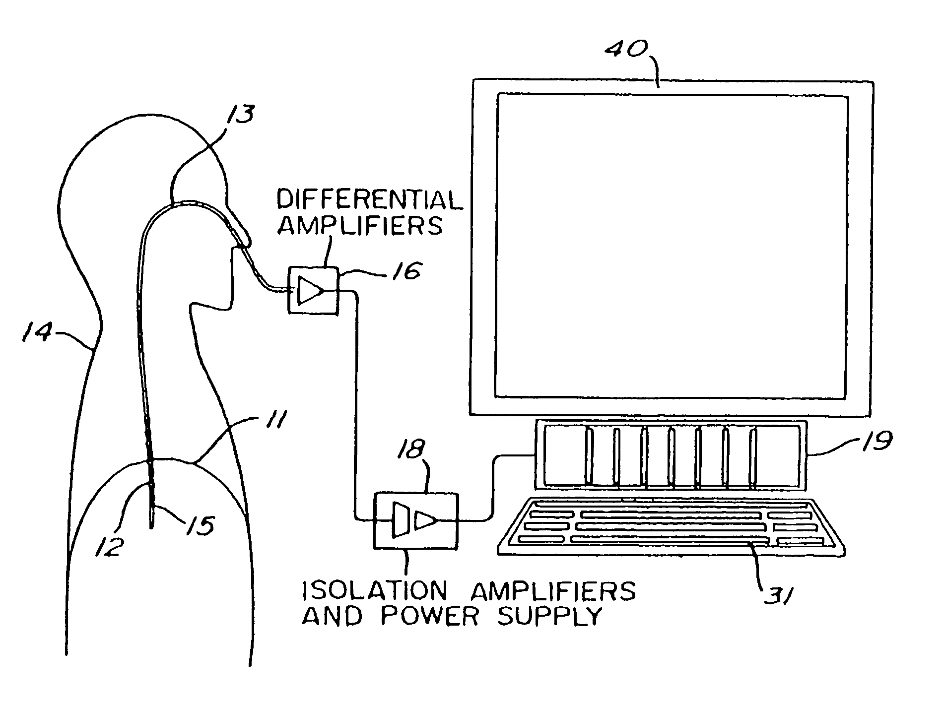 Proportional pressure assist ventilation controlled by a diaphragm electromyographic signal