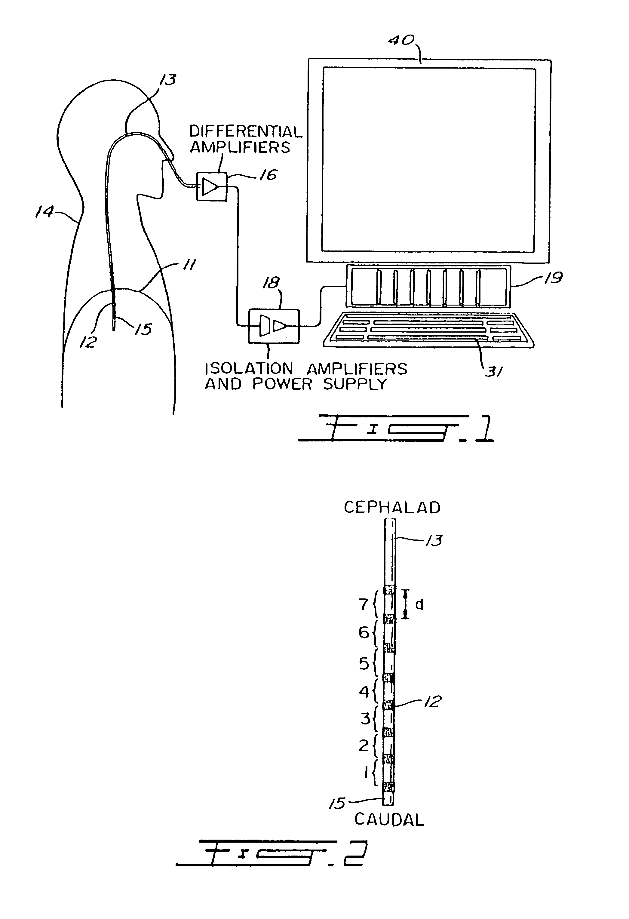 Proportional pressure assist ventilation controlled by a diaphragm electromyographic signal