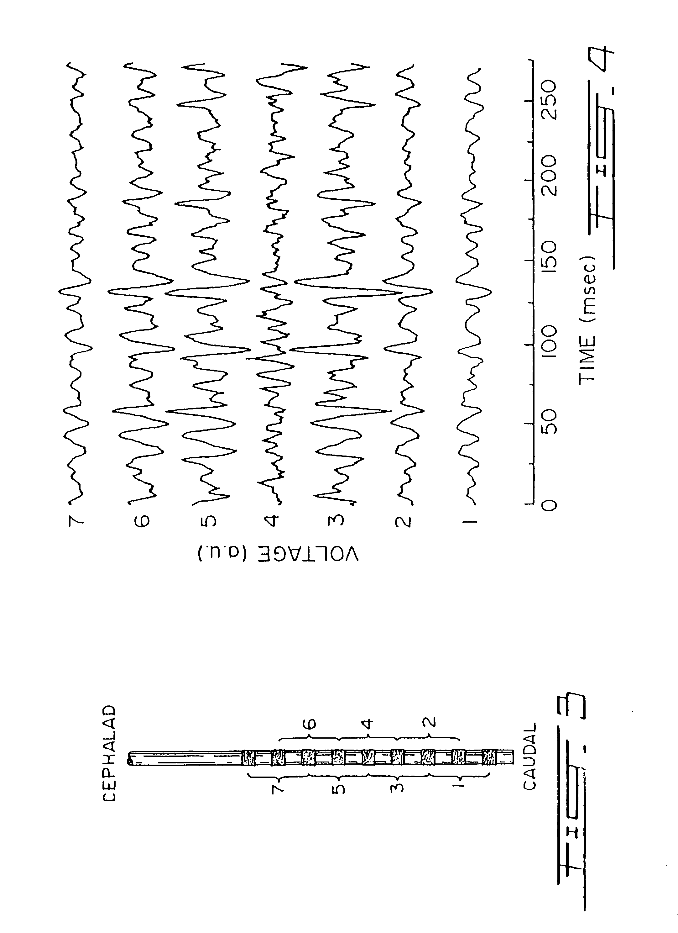 Proportional pressure assist ventilation controlled by a diaphragm electromyographic signal