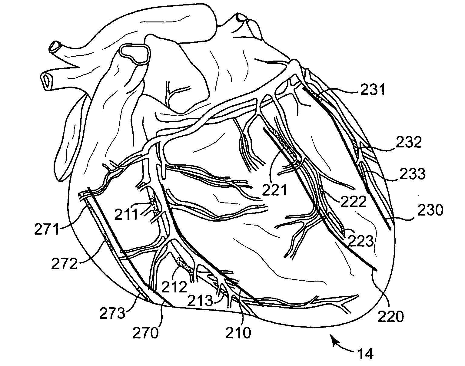 Cardiac repair, resizing and reshaping using the venous system of the heart