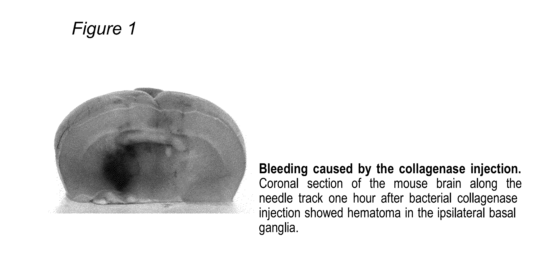 Endometrial regenerative cells for treatment of traumatic brain injury