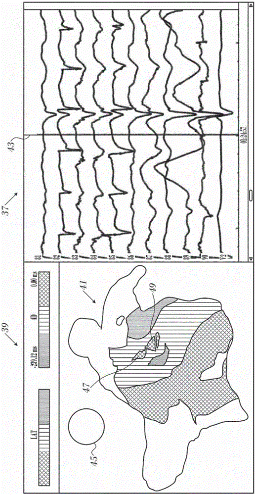 Ventricular electrical activity indicator