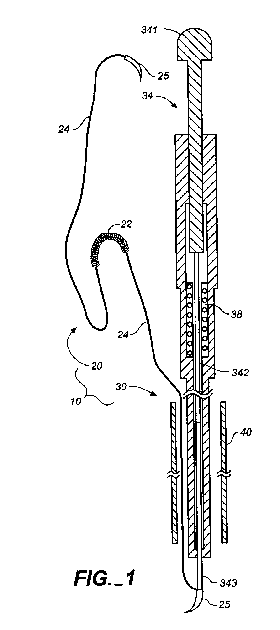 Minimally invasive valve repair procedure and apparatus