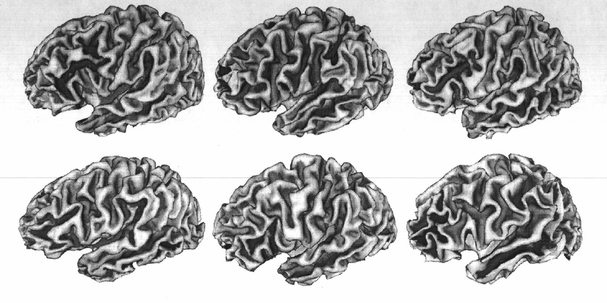 Method for segmenting sulus regions on surface of pallium of a three-dimensional cerebral magnetic resonance image