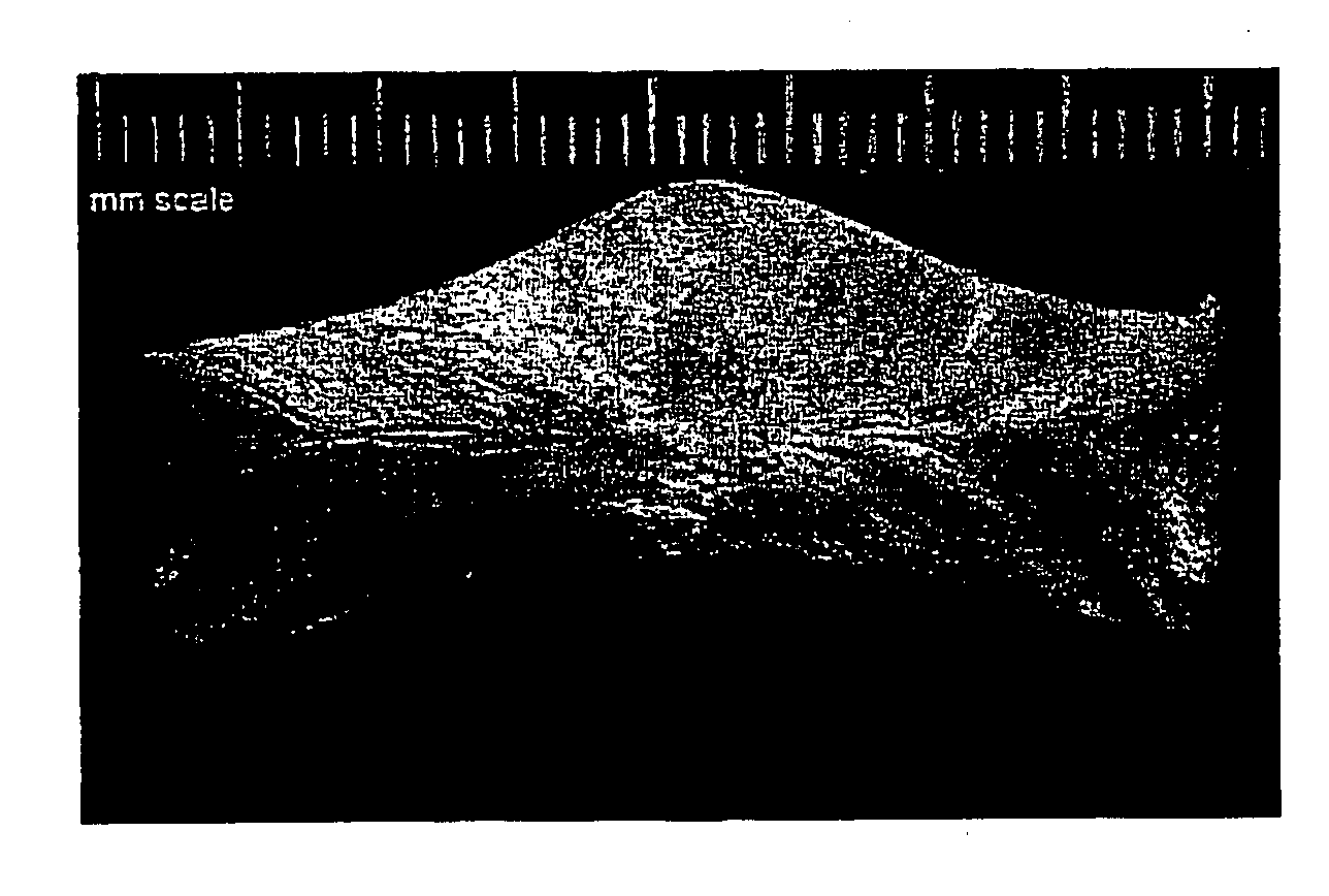 Wound dressings, apparatus, and methods for controlling severe, life-threatening bleeding