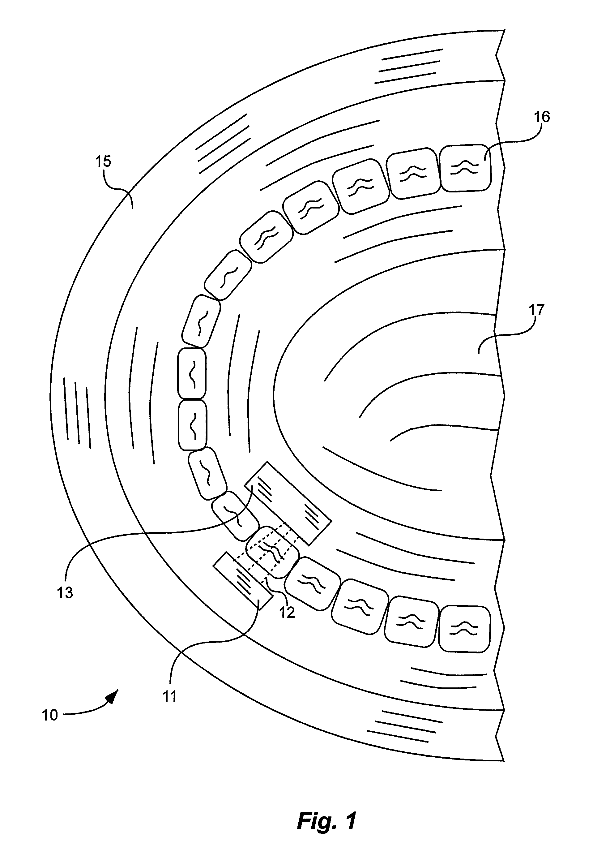 X-ray tube and receiver inside mouth