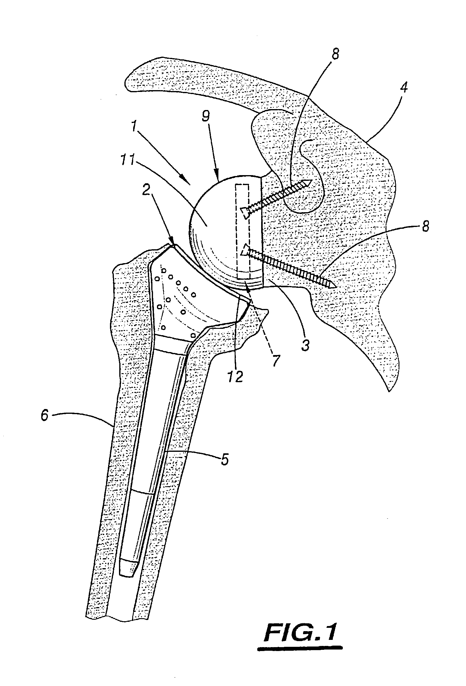 Shoulder prosthesis assembly