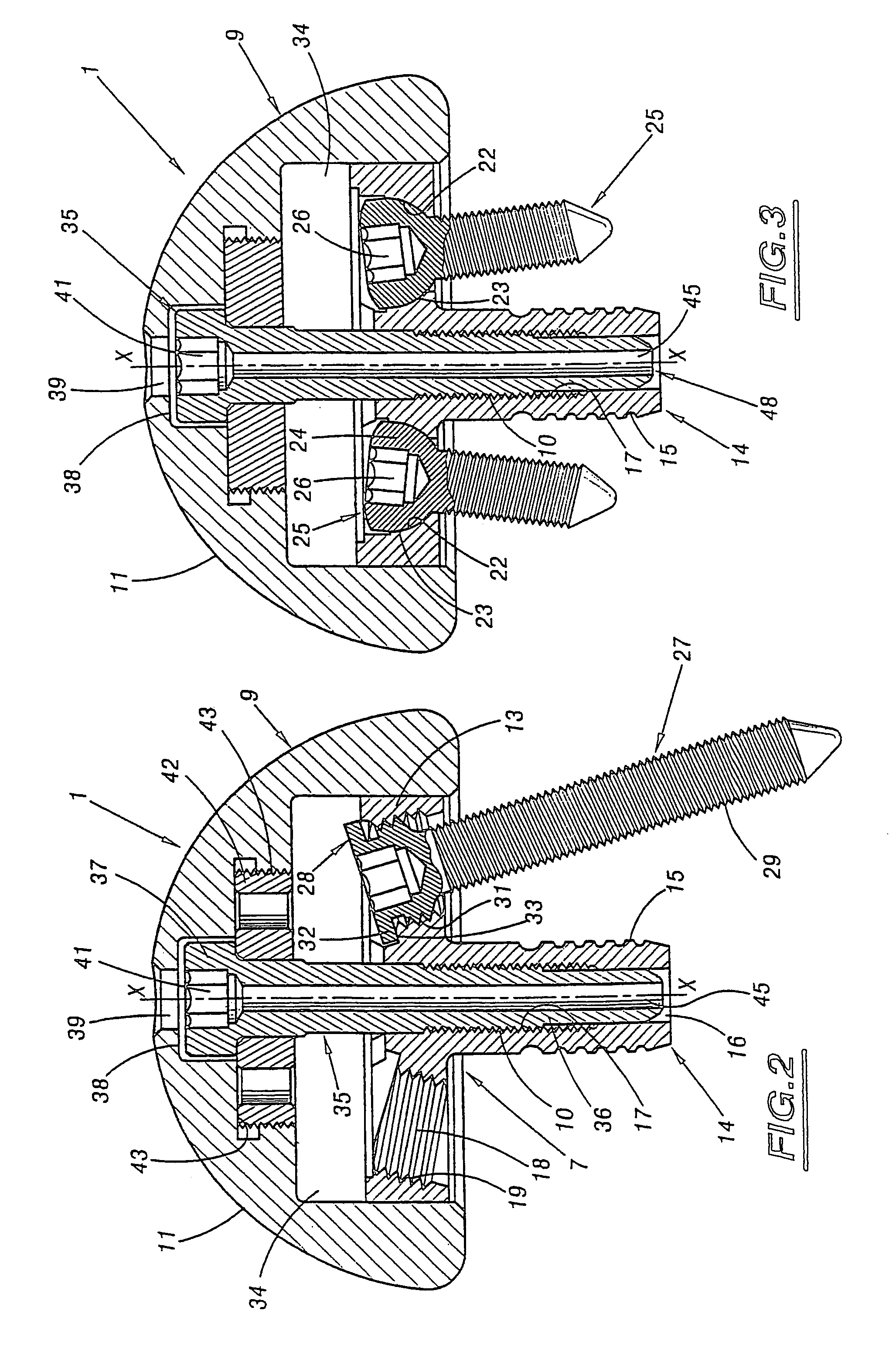 Shoulder prosthesis assembly