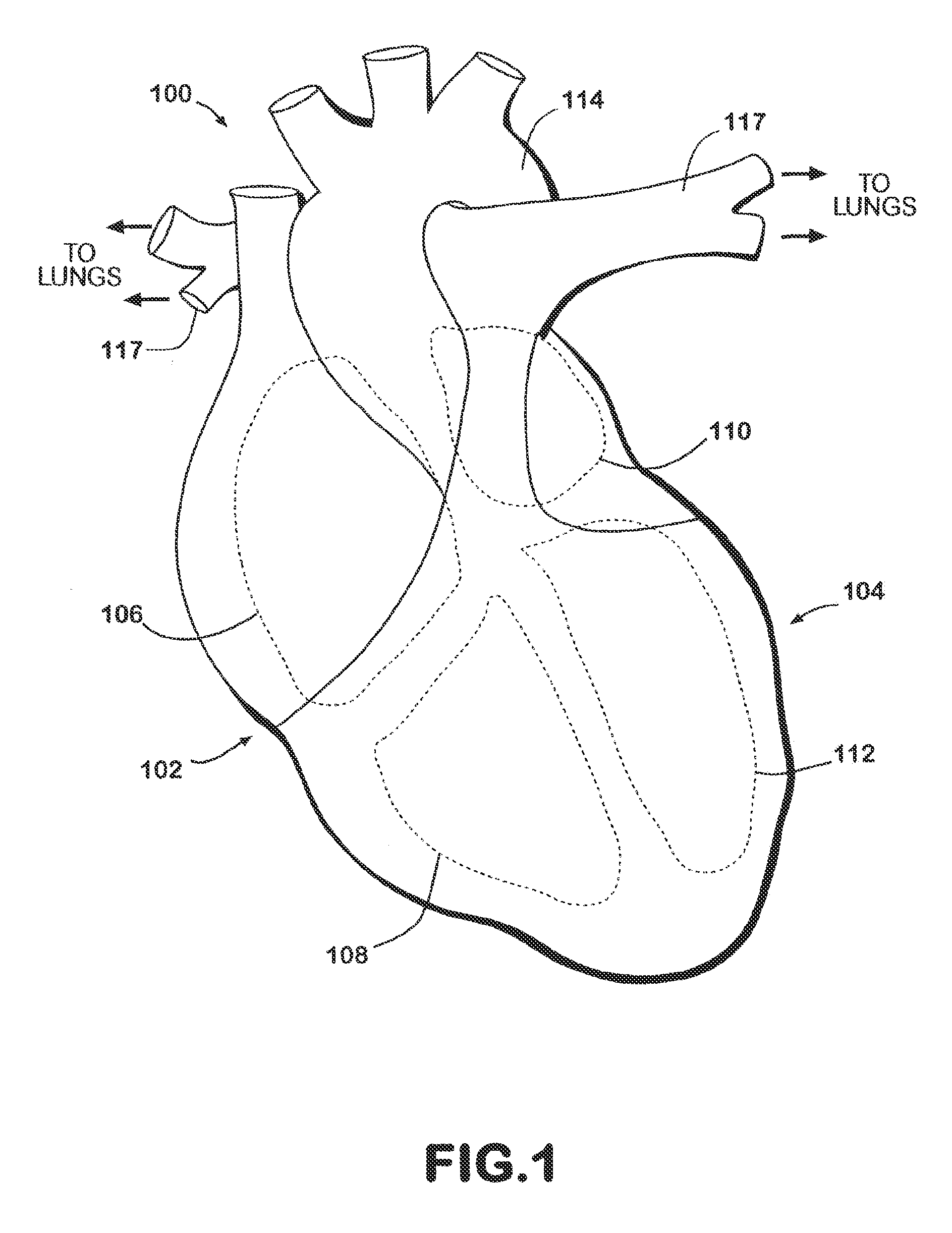 Cardiac resynchronization system employing mechanical measurement of cardiac walls