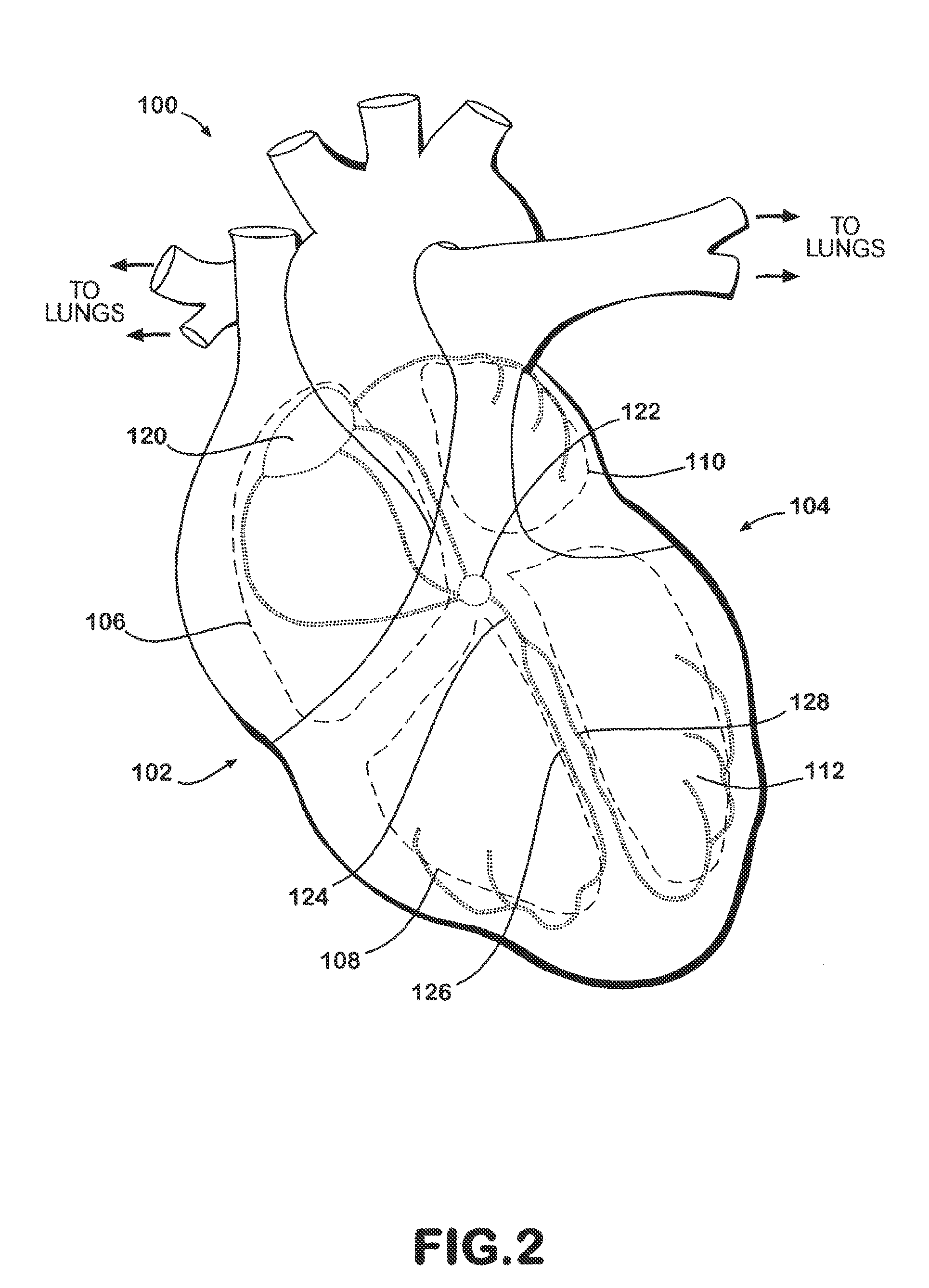 Cardiac resynchronization system employing mechanical measurement of cardiac walls