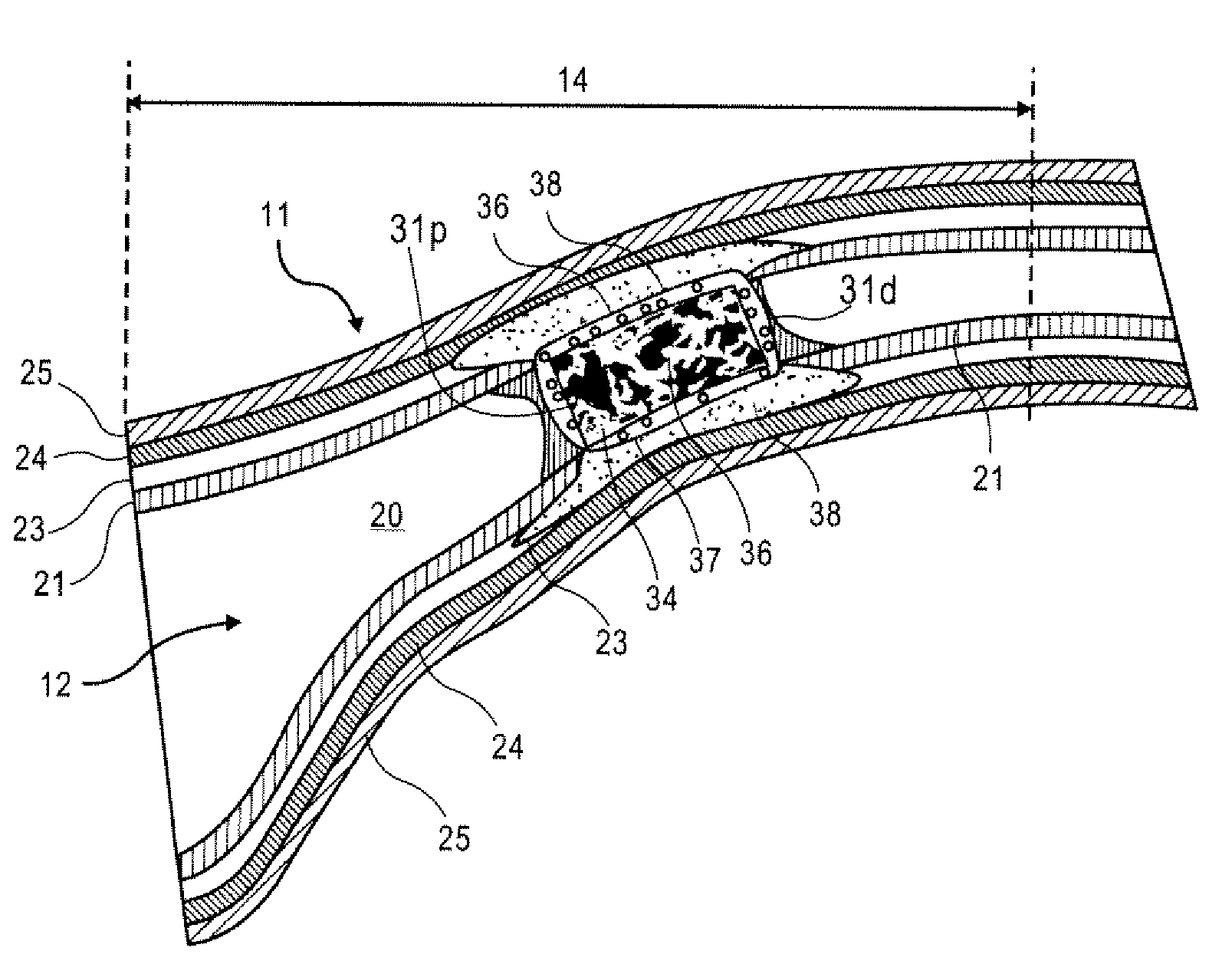 Methods and devices for occluding an ovarian pathway