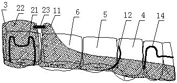 Mixed-dentition maxillary occlusal pad molar distal jet