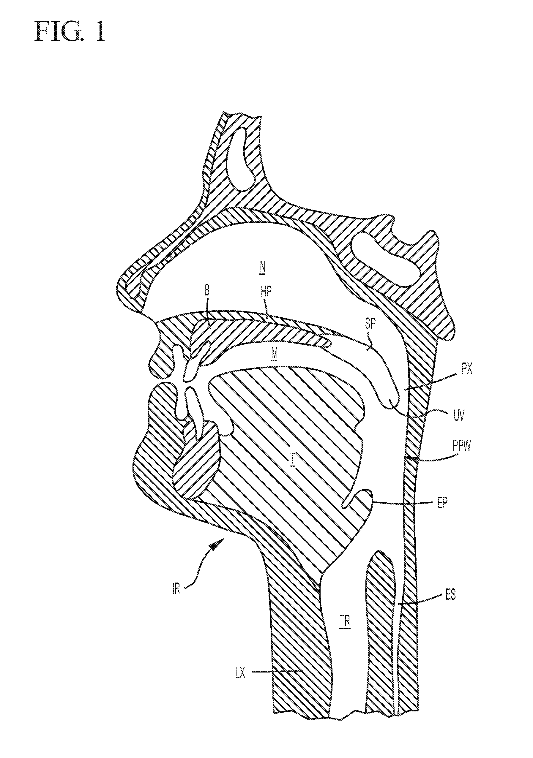 Flexible implants having internal volume shifting capabilities for treating obstructive sleep apnea