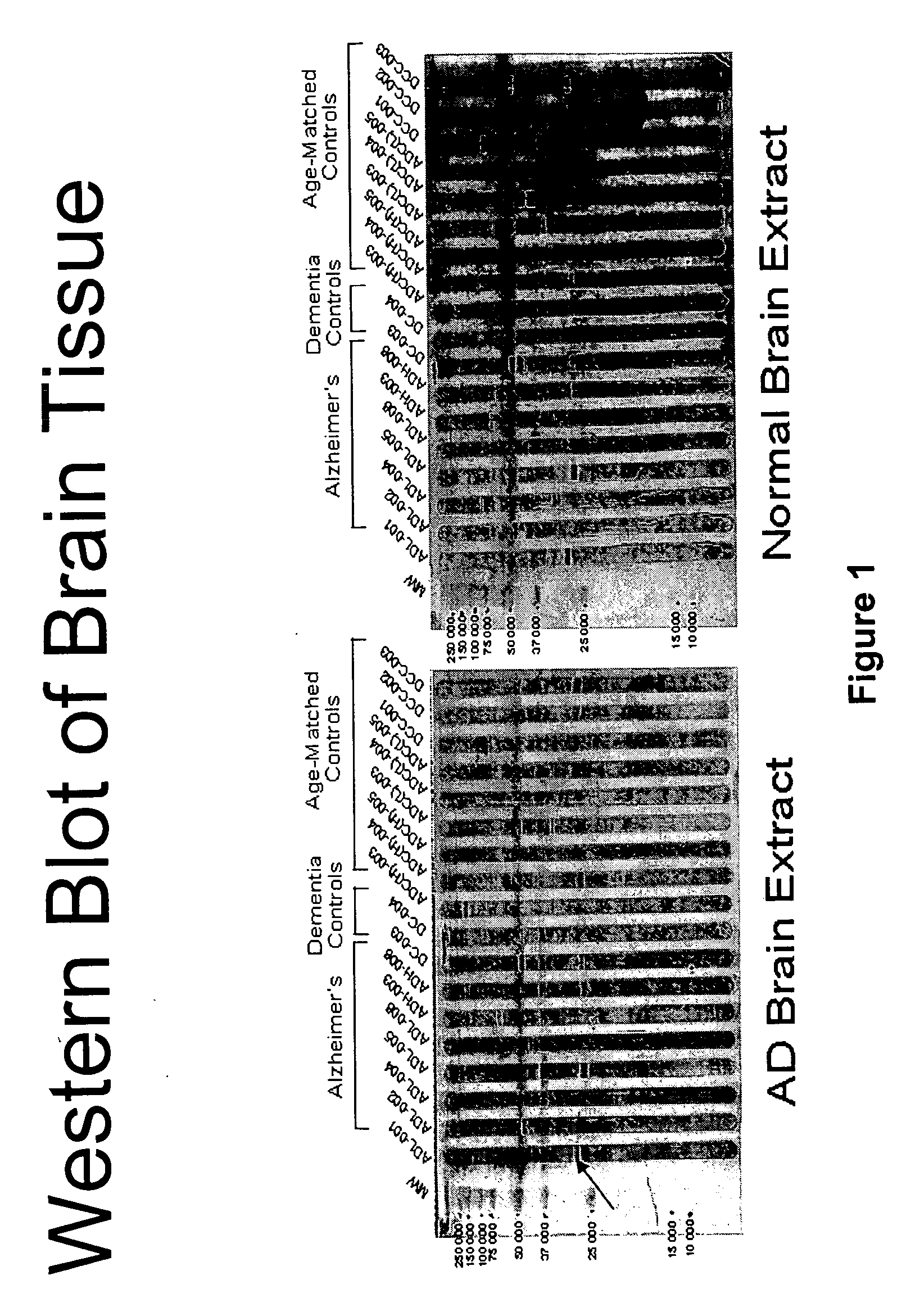 Method for retarding or precluding Alzheimer's dementia