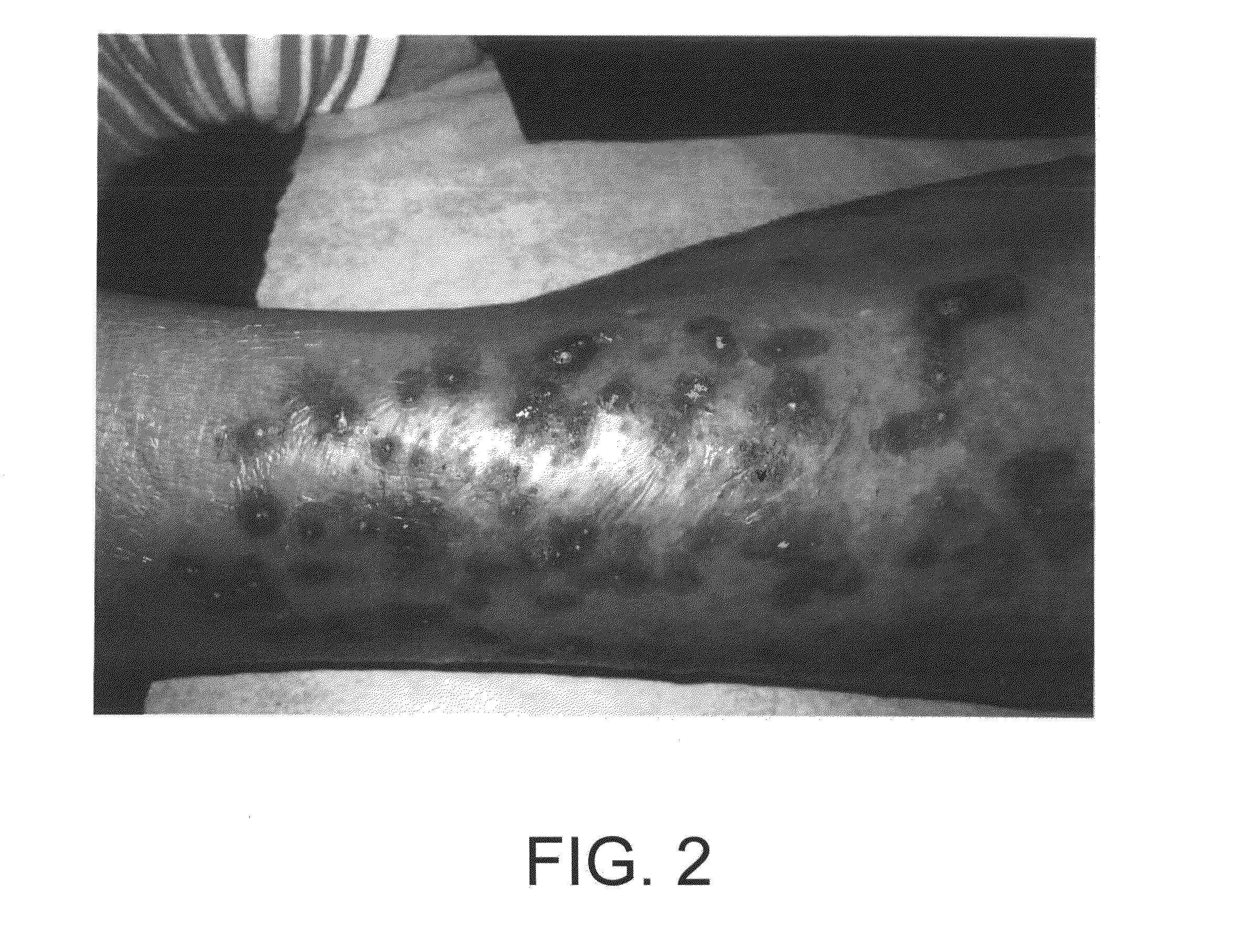 Method of treating acquired perforating dermatosis with cantharidin