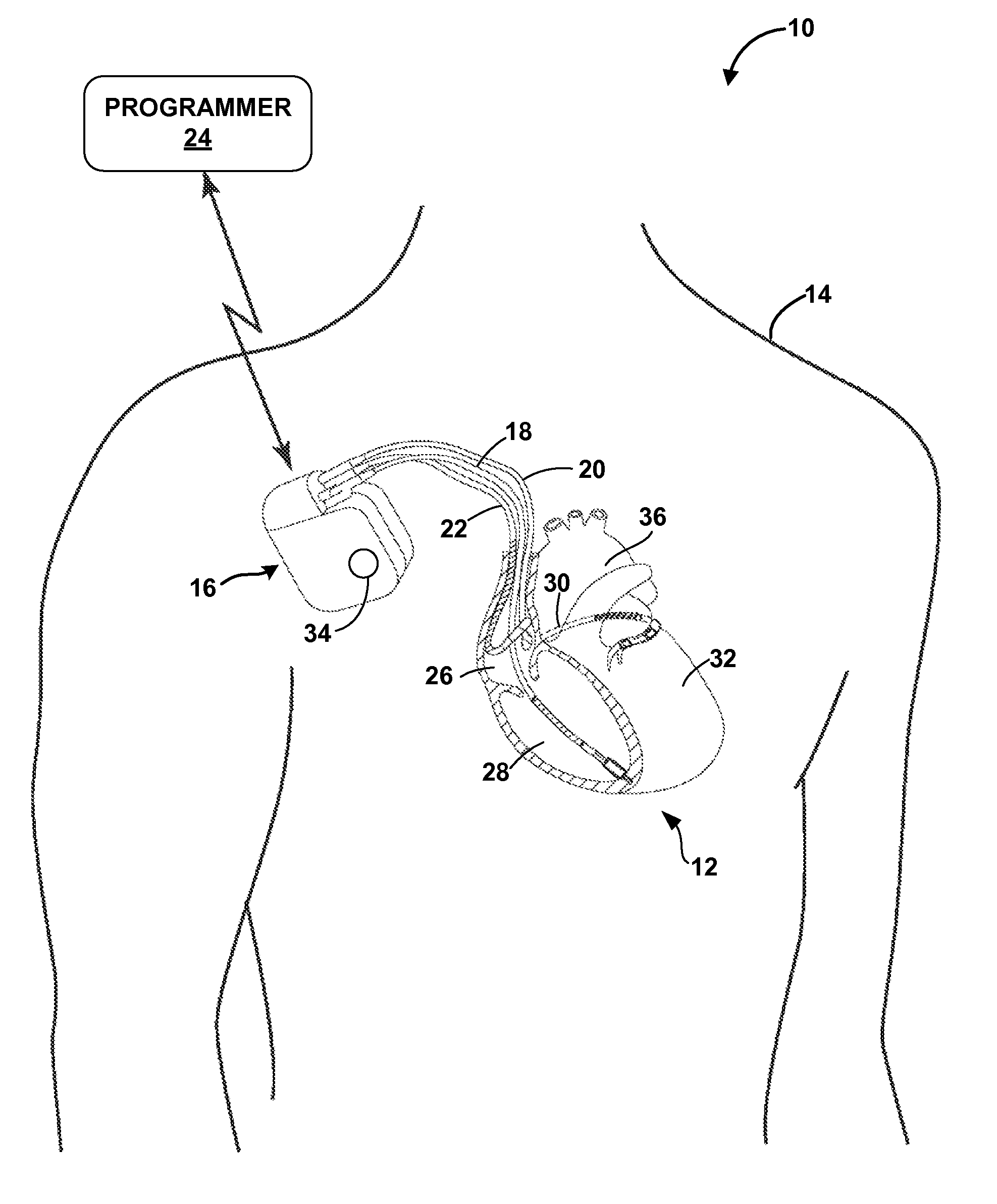 Detecting worsening heart failure based on impedance measurements