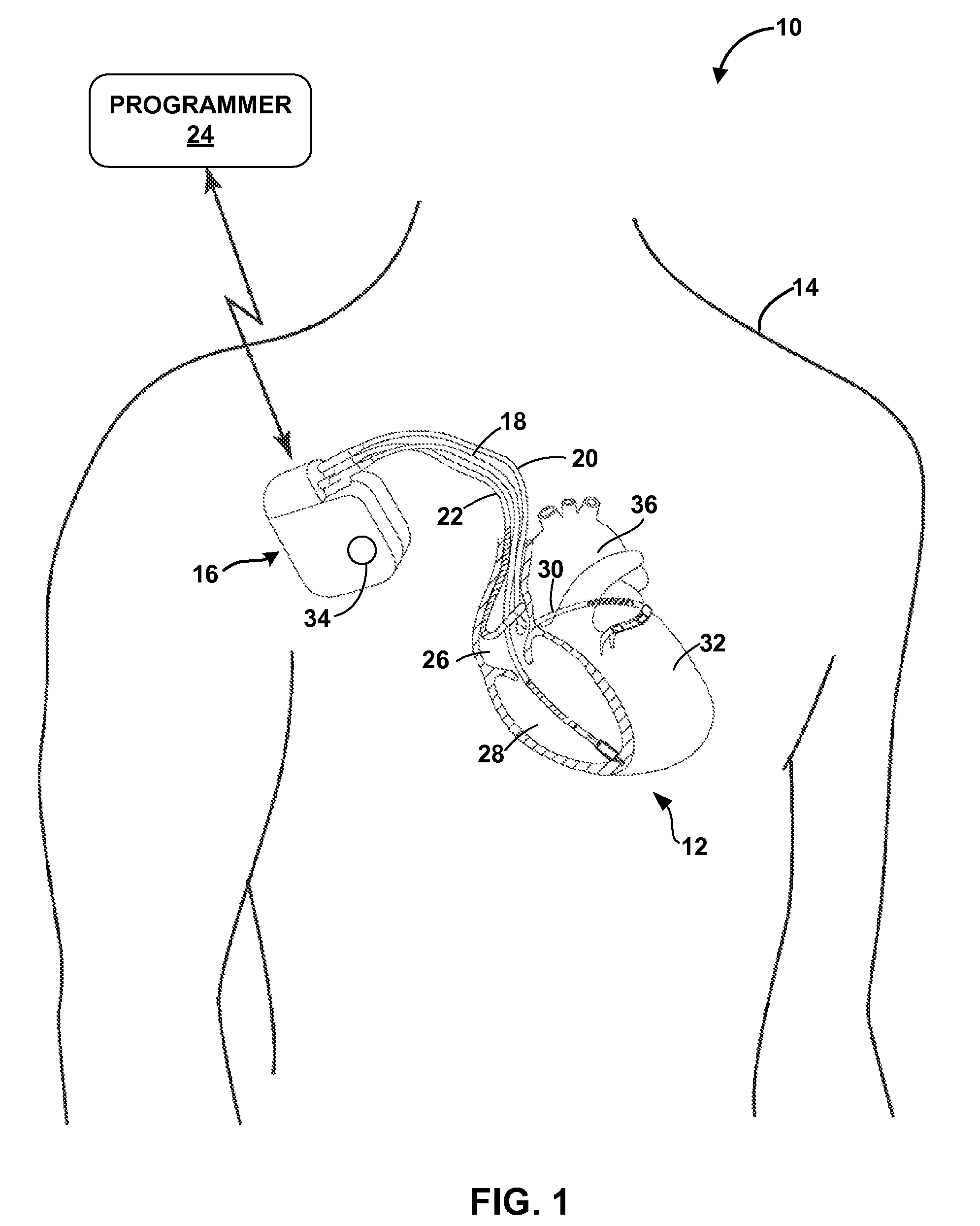 Detecting worsening heart failure based on impedance measurements