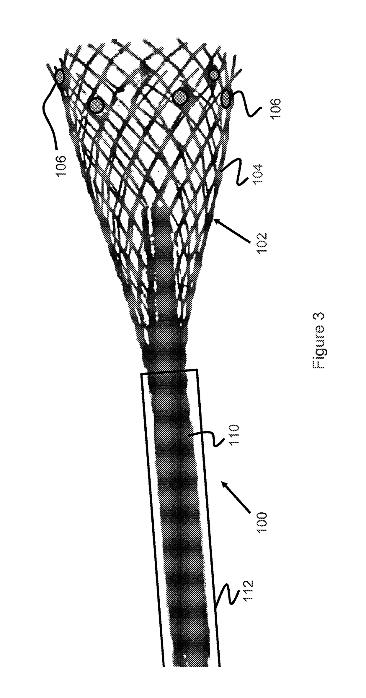 Implant Retention, Detachment, And Delivery System