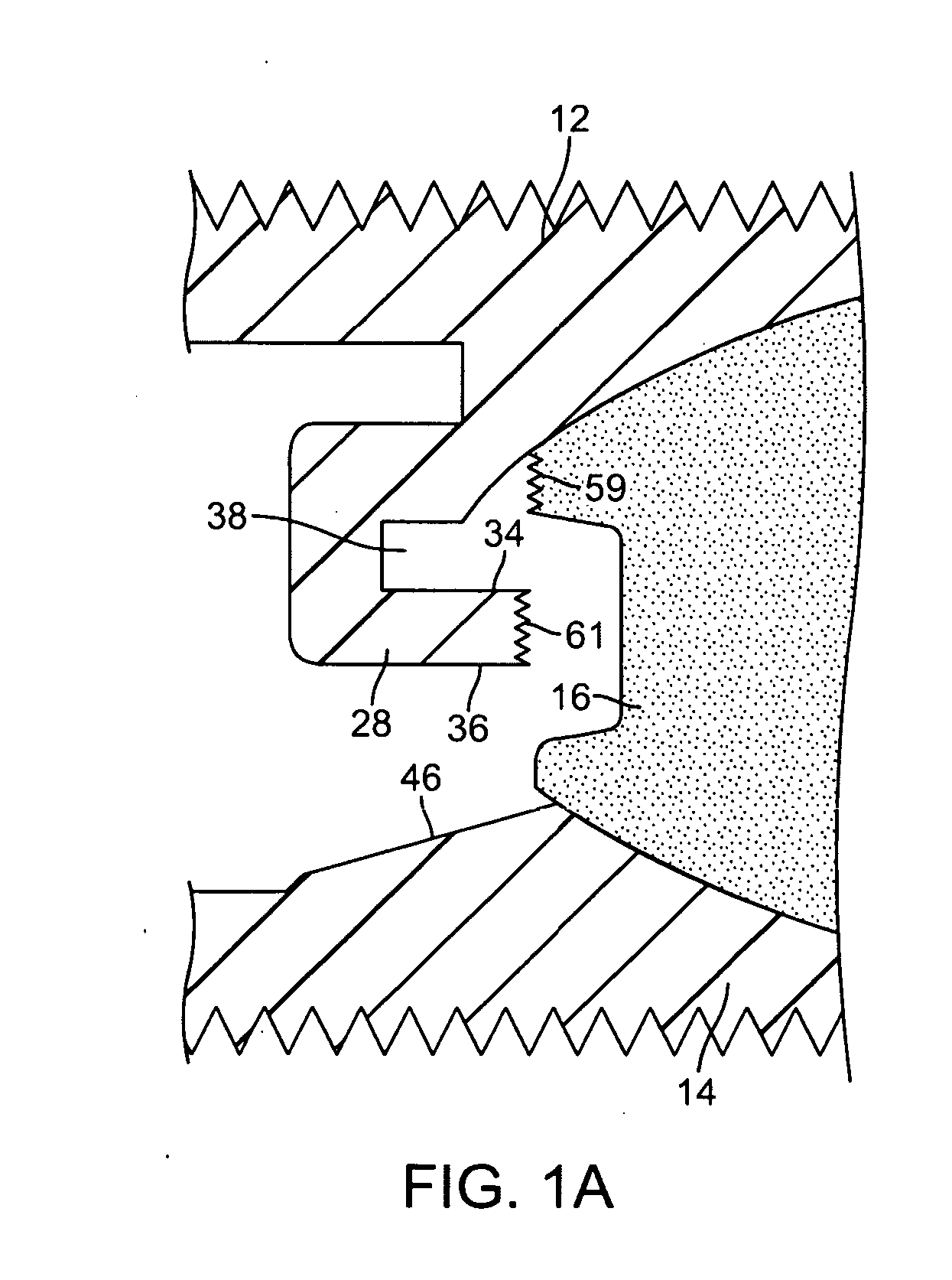 Intervertebral Prosthetic Disc With Metallic Core