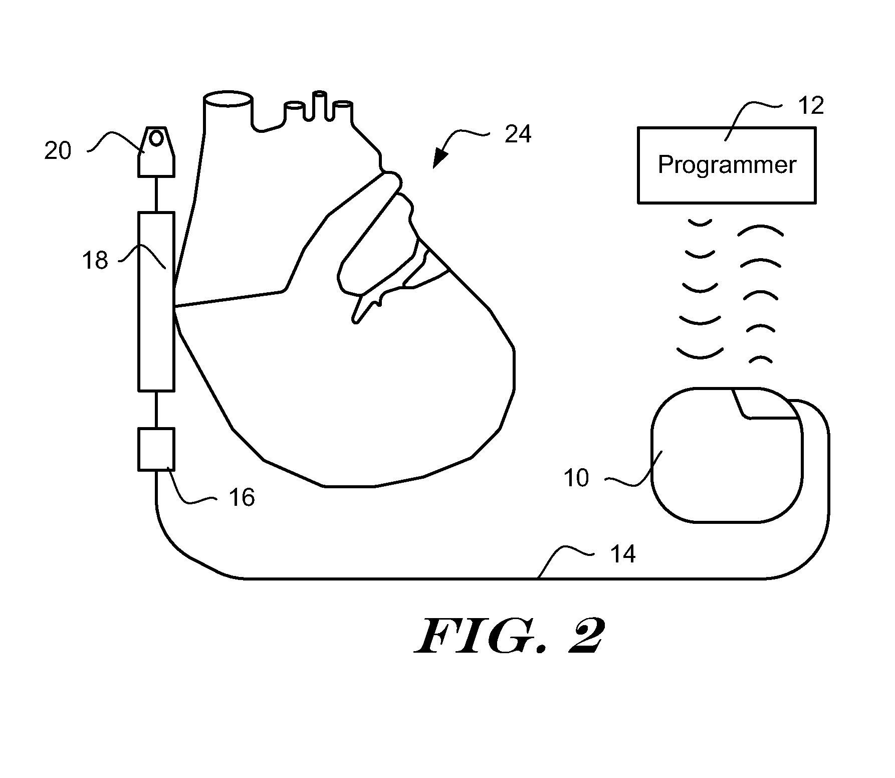 Antitachycardia Pacing Pulse from a Subcutaneous Defibrillator