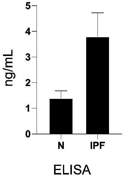 Idiopathic pulmonary fibrosis disease diagnosis marker and application thereof in preparing diagnosis or prognosis tool