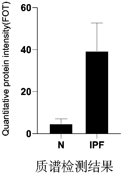 Idiopathic pulmonary fibrosis disease diagnosis marker and application thereof in preparing diagnosis or prognosis tool