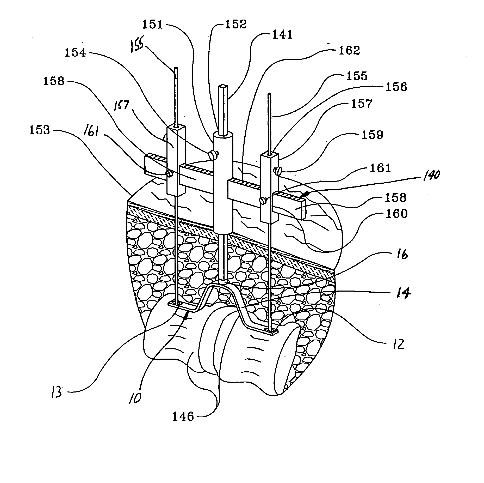 Artificial spinal joints and method of use