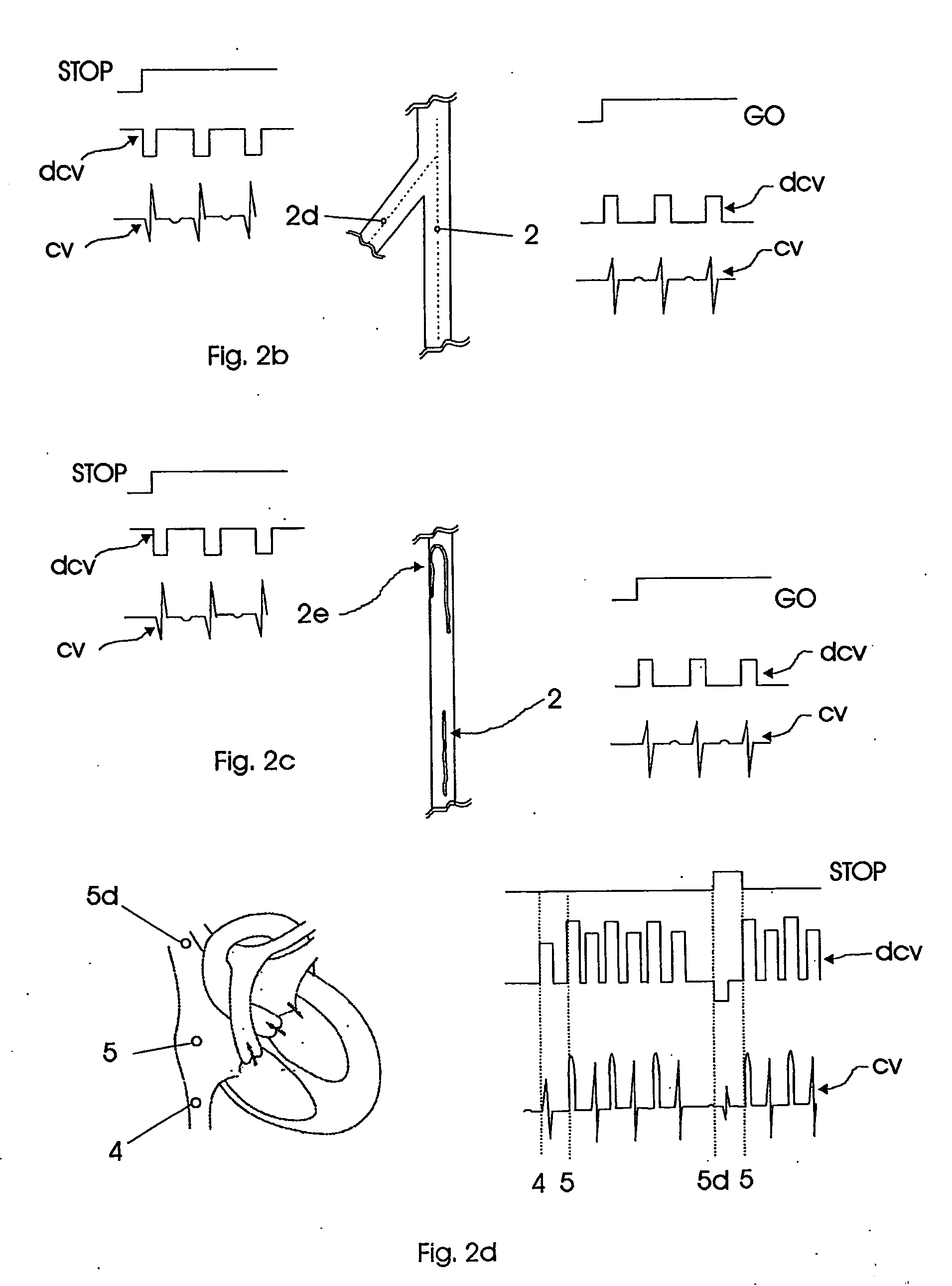 Catheterization method and system