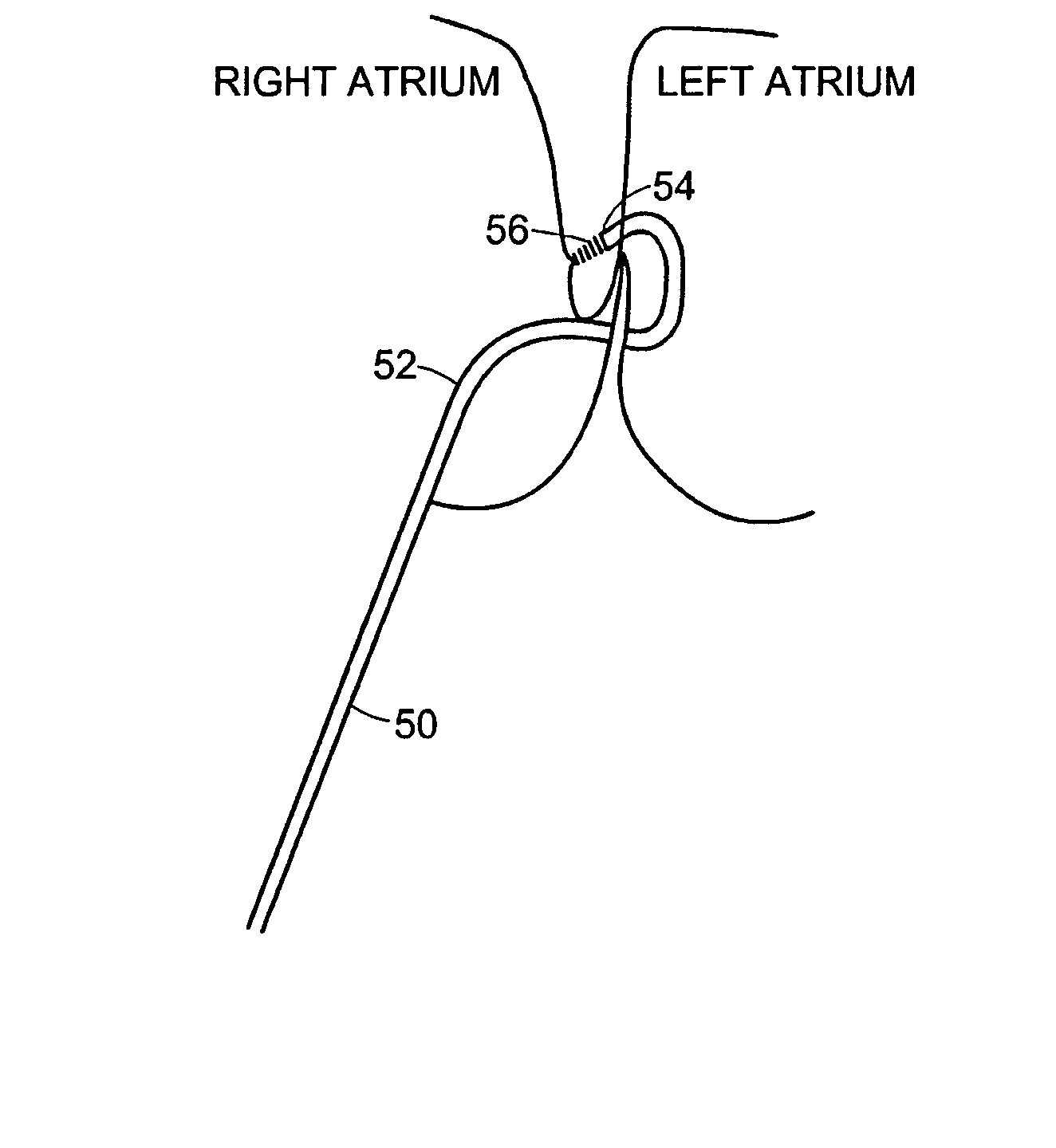 Patent foramen ovale (PFO) closure method and device