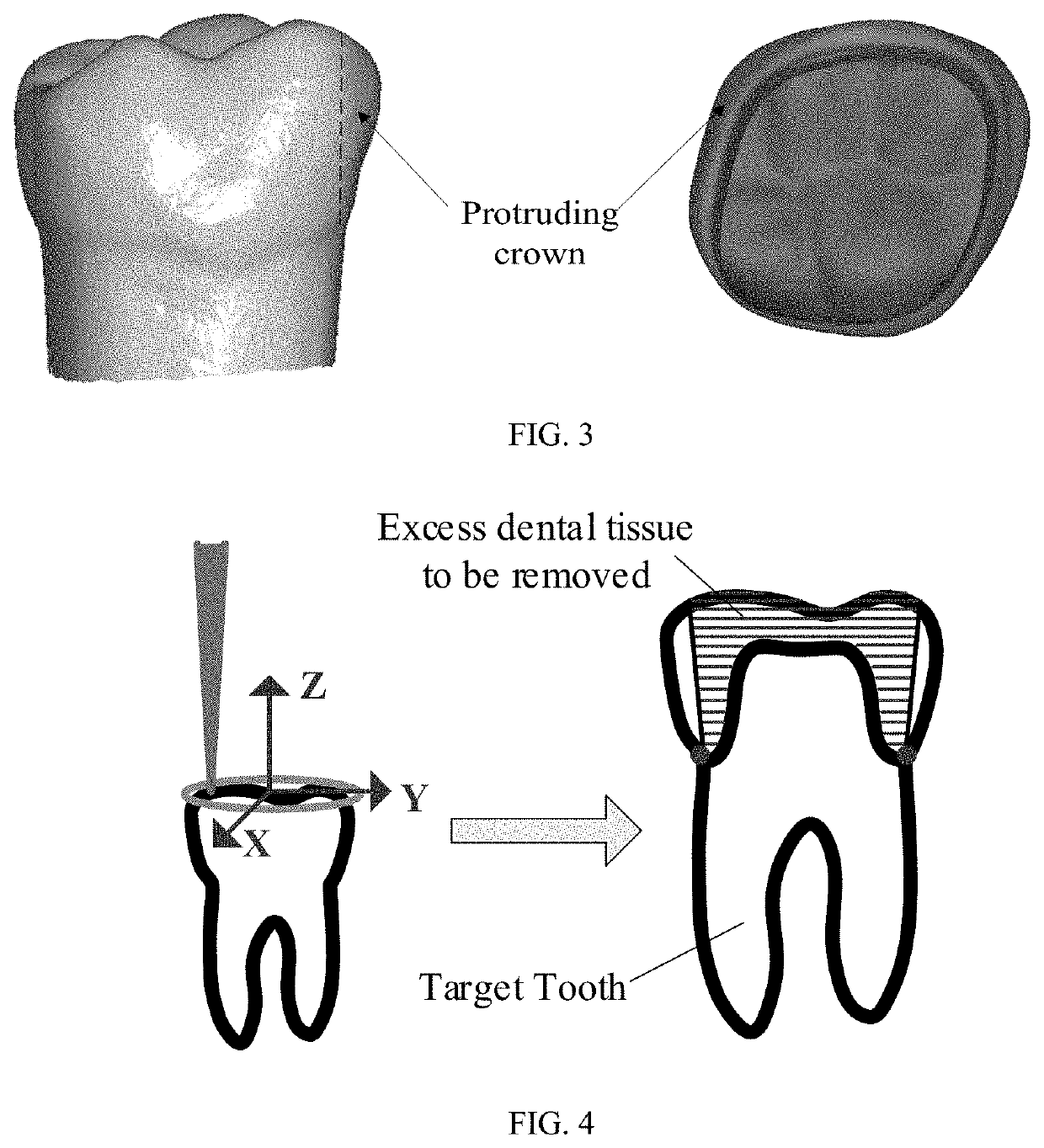 Peeling type laser tooth preparing method, apparatus and device, and medium