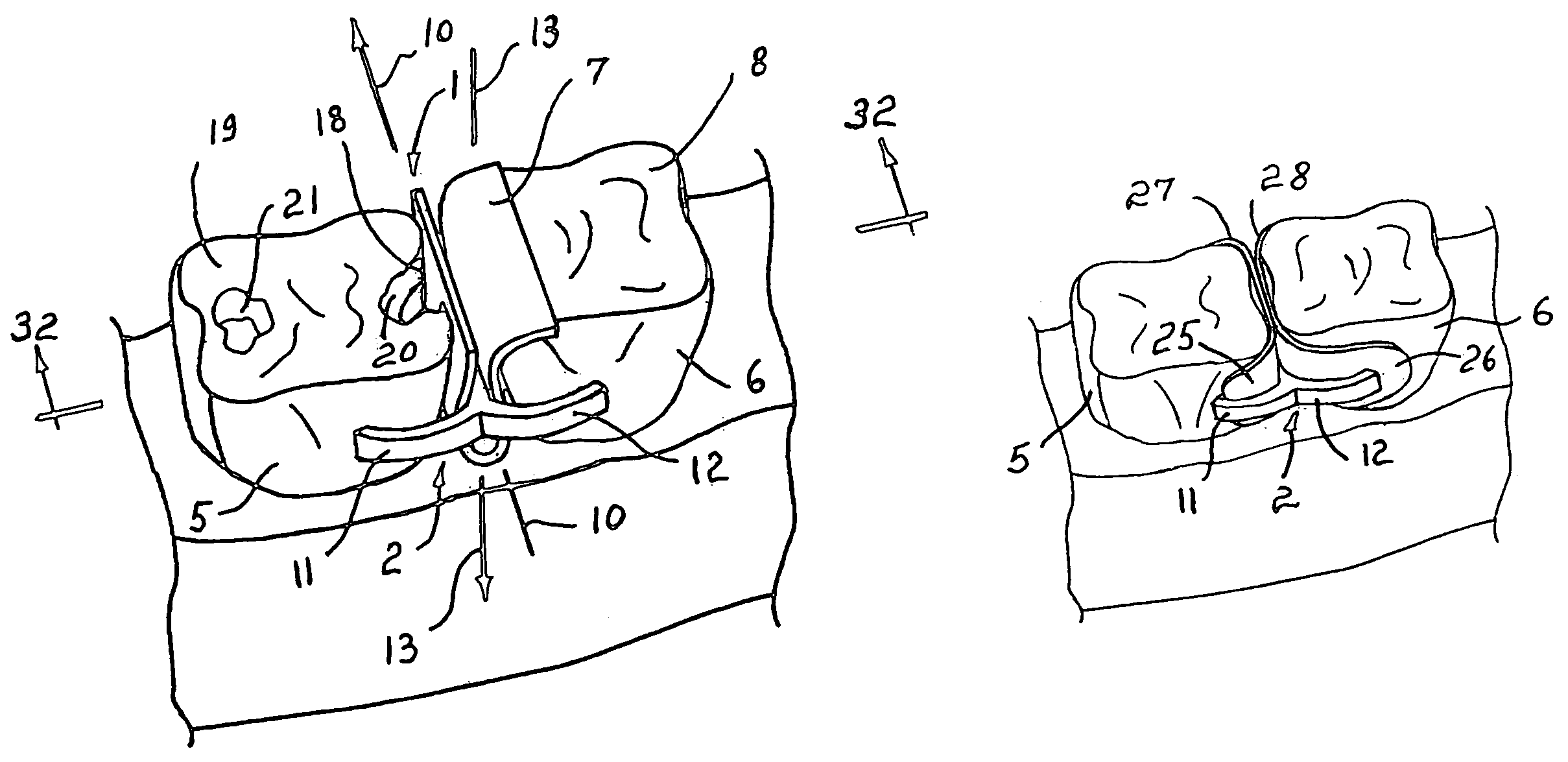 Dental tooth spacer assembly