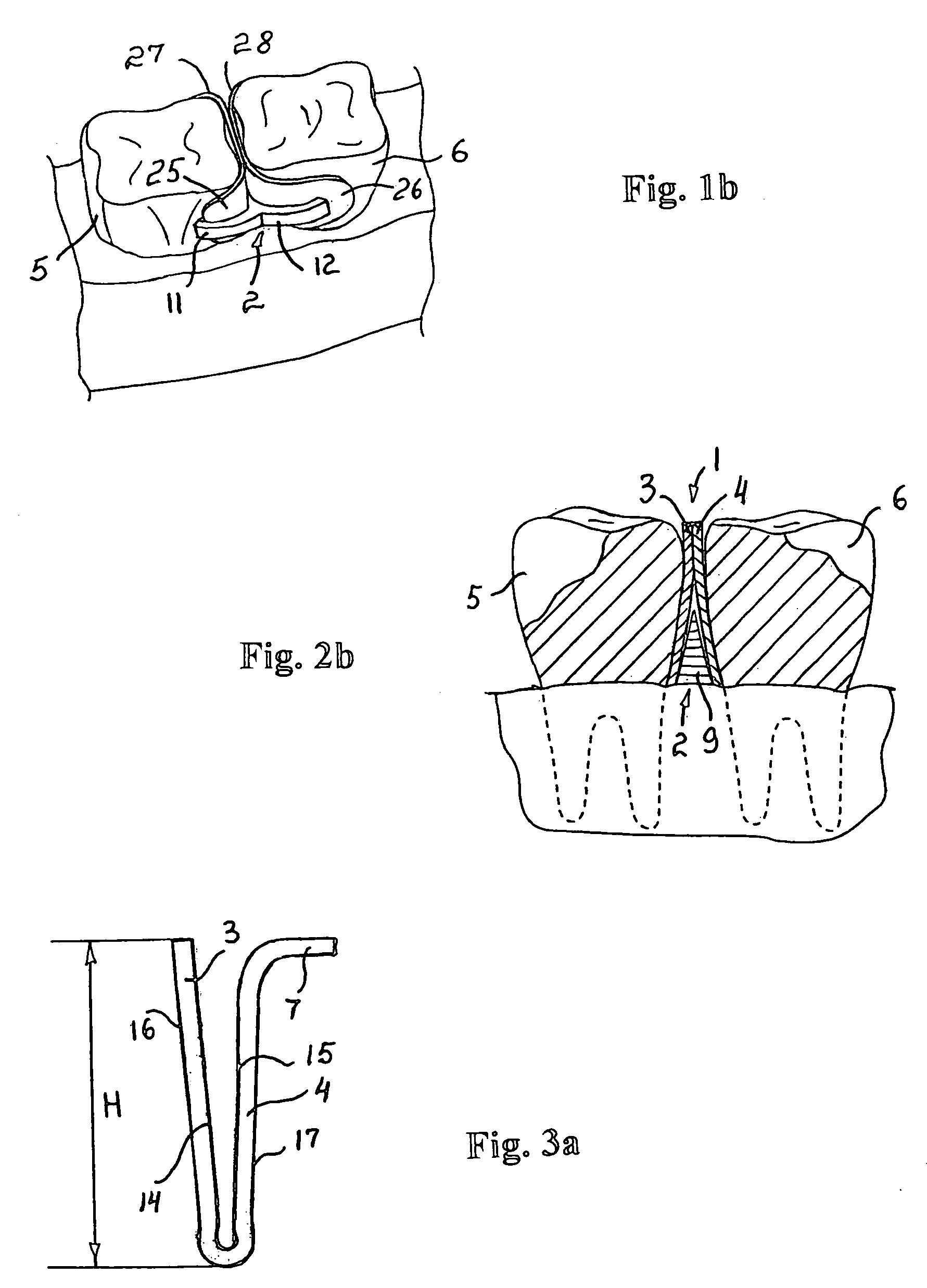 Dental tooth spacer assembly