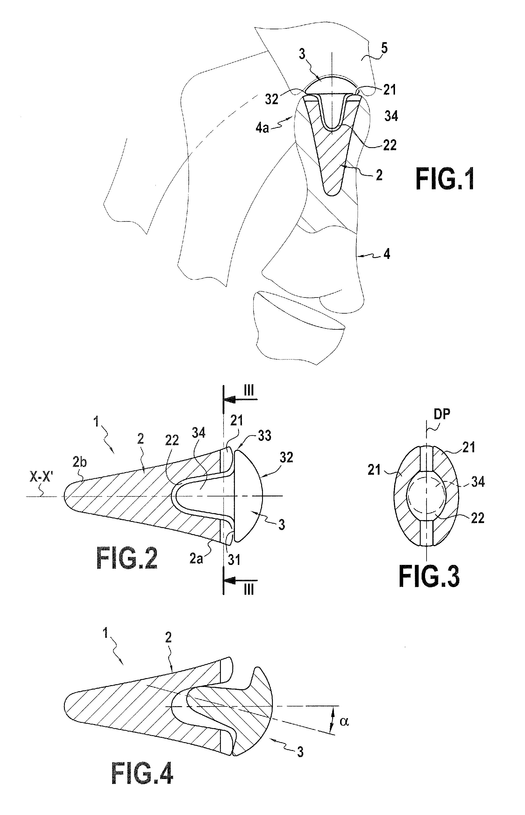 Trapezo-metacarpal implant