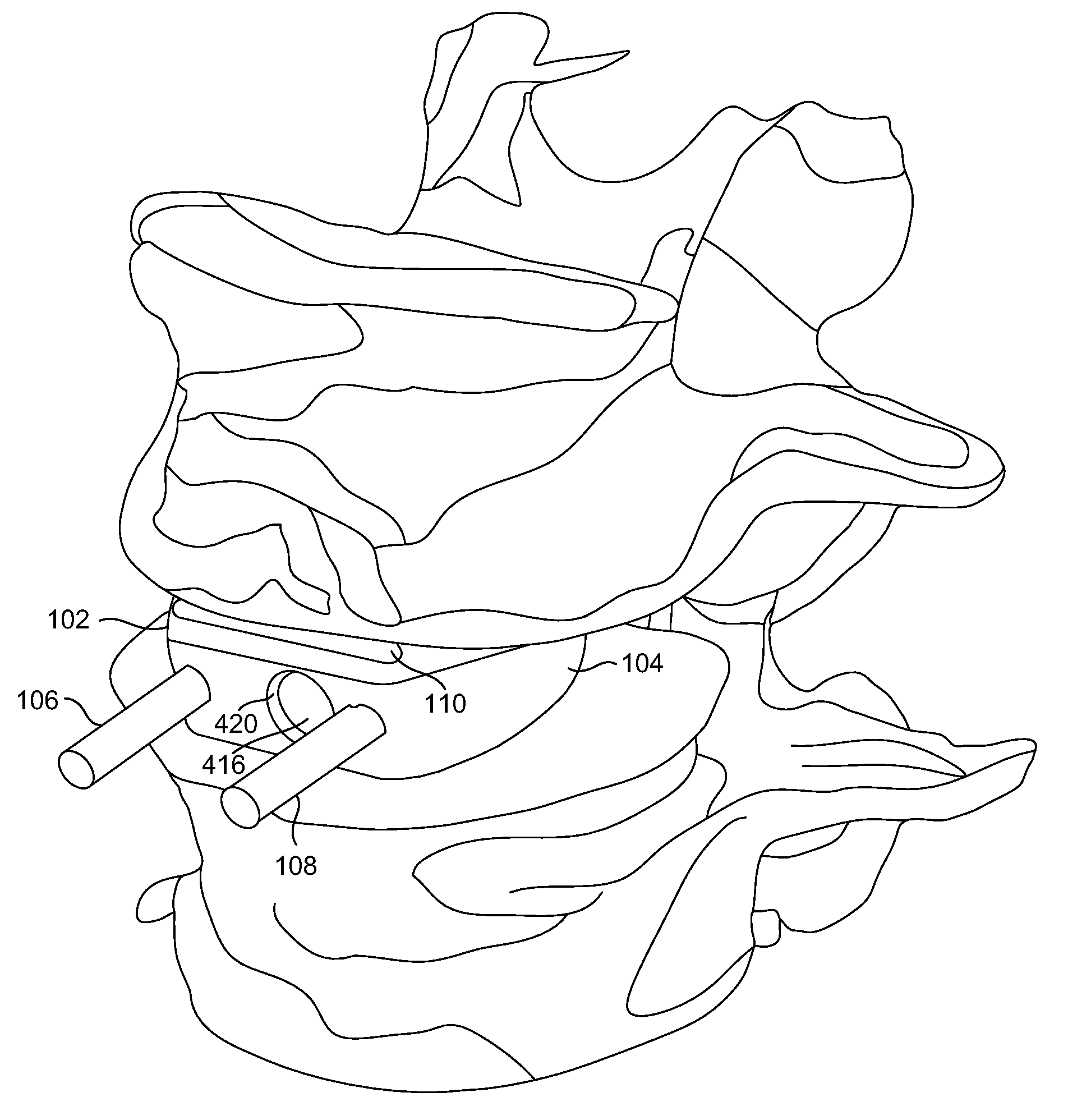 Modular lateral expansion device