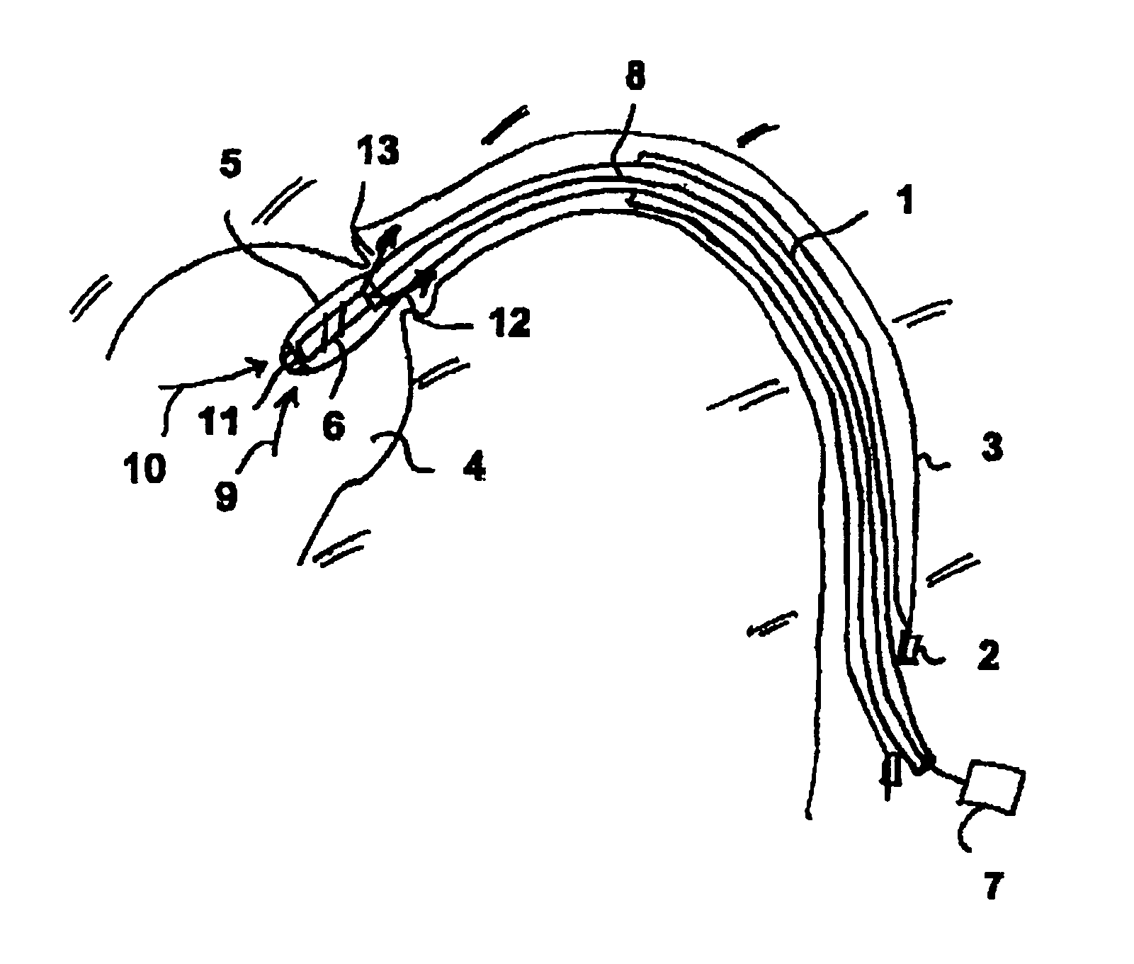 Fluid pump having a radially compressible rotor