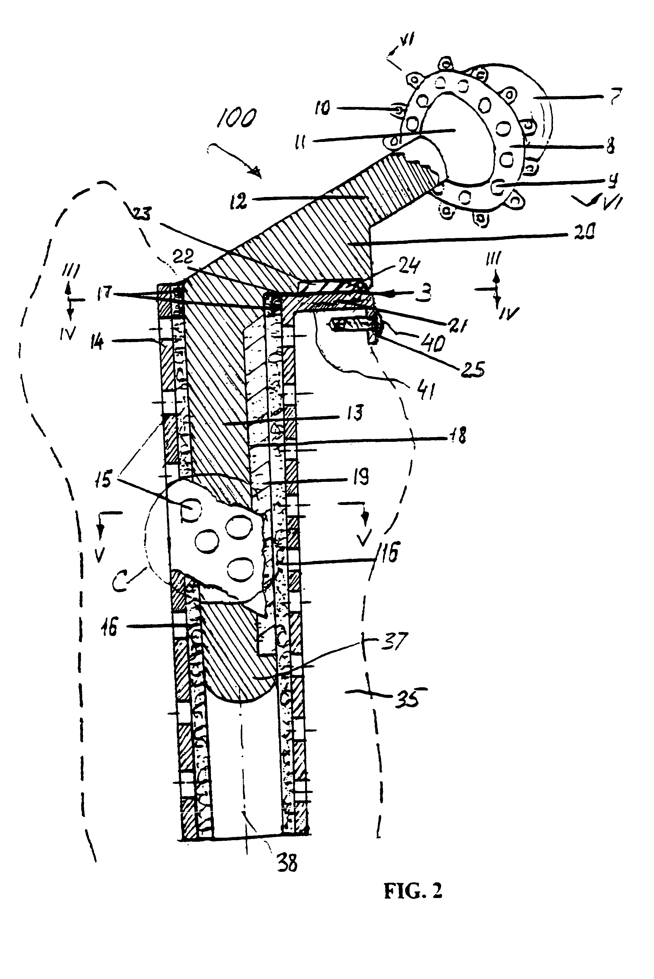 Hip prosthesis