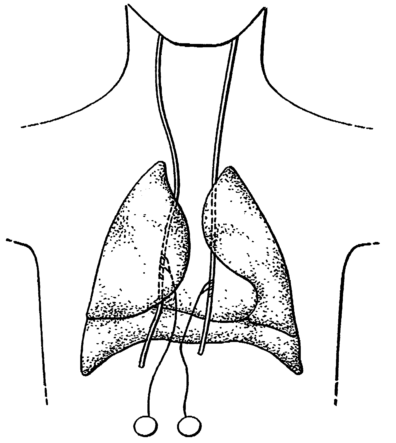 Treatment of obesity by bilateral vagus nerve stimulation