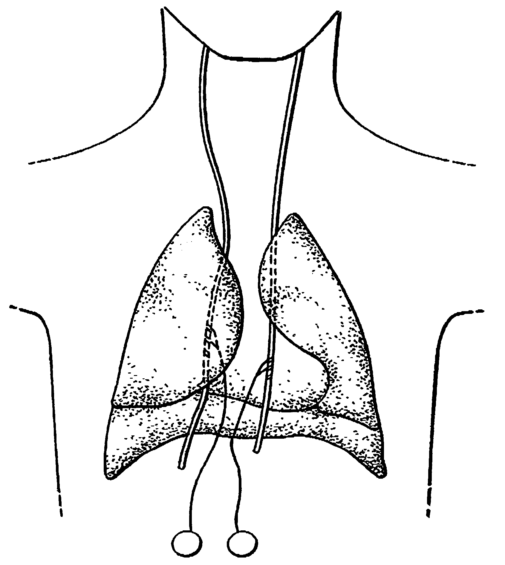 Treatment of obesity by bilateral vagus nerve stimulation