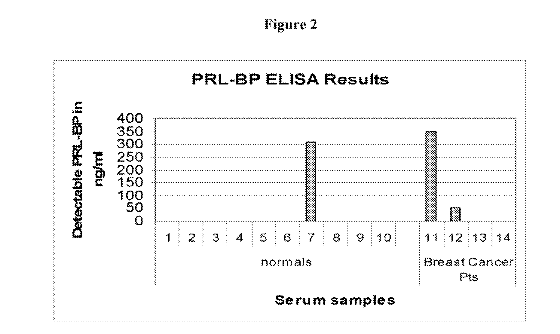 Serum Prolactin Binding Protein in Epithelial Carcinoma