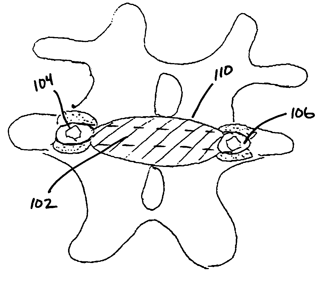 Devices to prevent spinal extension