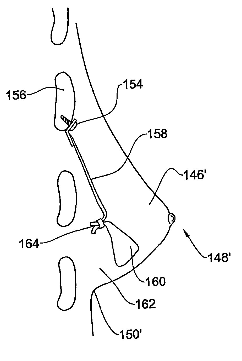 System and method for breast lifting