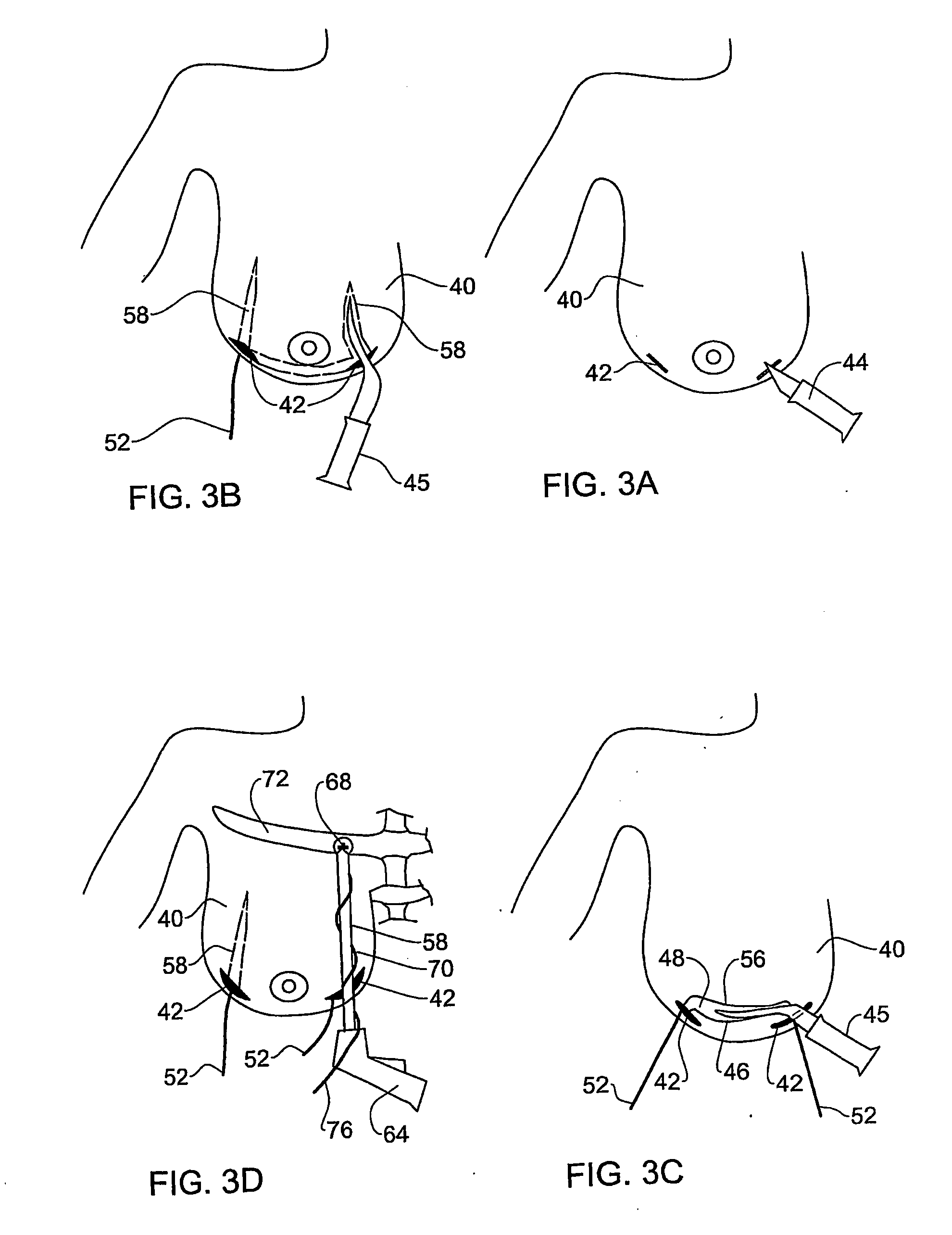 System and method for breast lifting