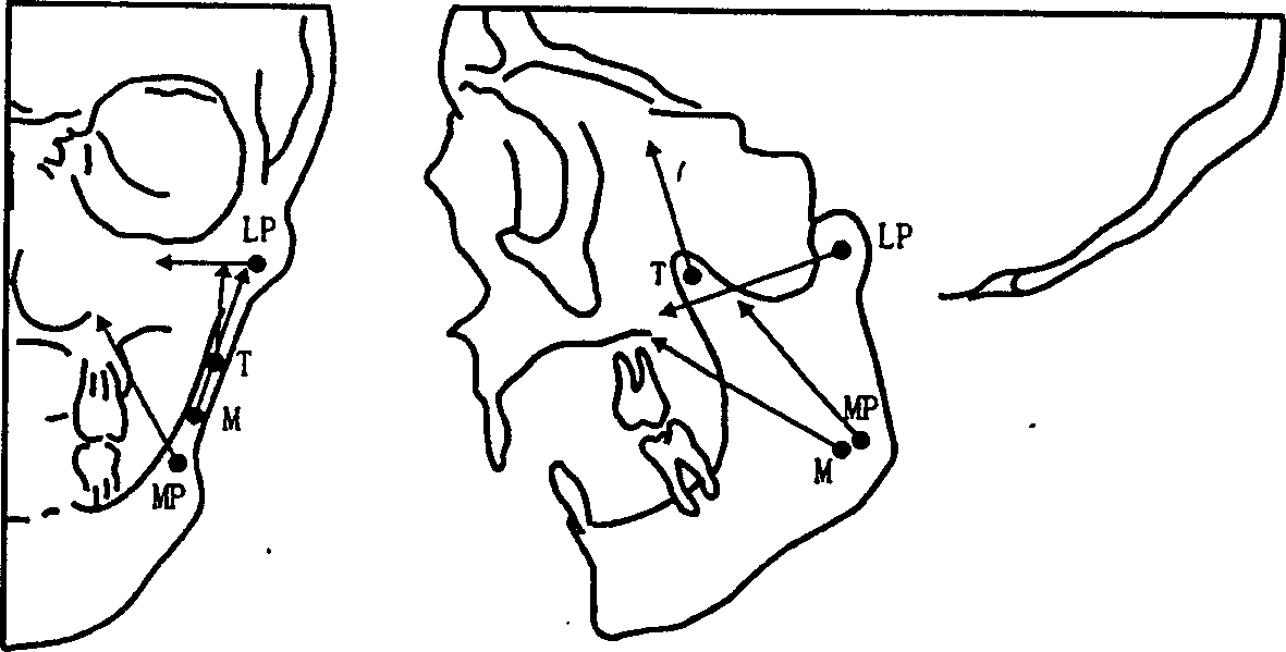 Biomechanical model of human lower jawbone