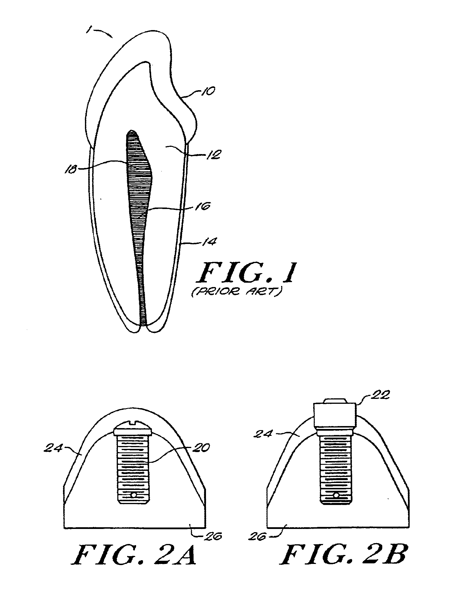 Method for fabricating endodontic, orthodontic, and direct restorations having infused ceramic network