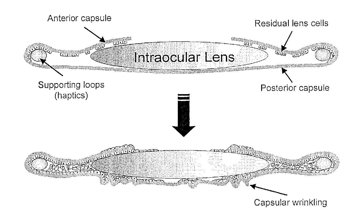 Treatment of fibrotic eye disorders using an mmp2 inhibitor