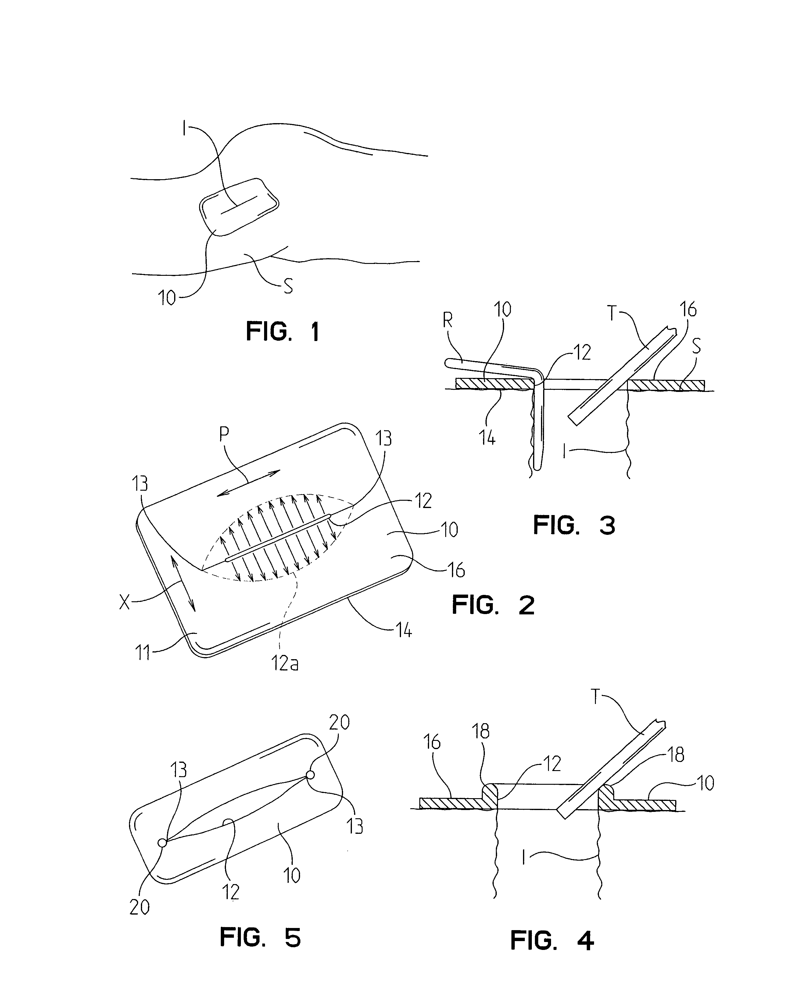 Devices and methods for protecting tissue at a surgical site